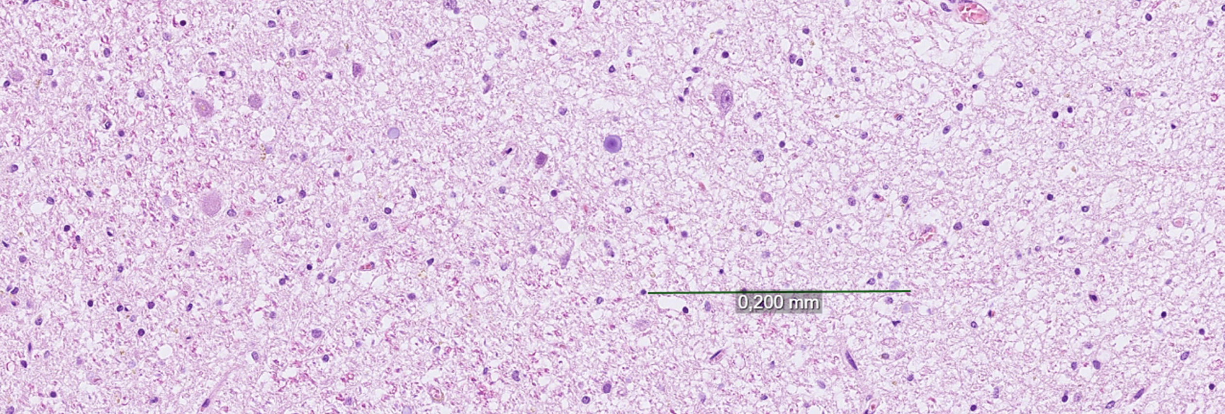 Example image of the locus coeruleus (LC) in neuropathological case diagnosed with frontotemporal lobar degeneration (FTLD) with tau proteinopathy at 13x magnification. Demonstrated in the image is a degenerated LC with a degeneration score of 9 points of 9 possible according to assessment tool introduced in the study. Scale bar representing 0.2 mm.