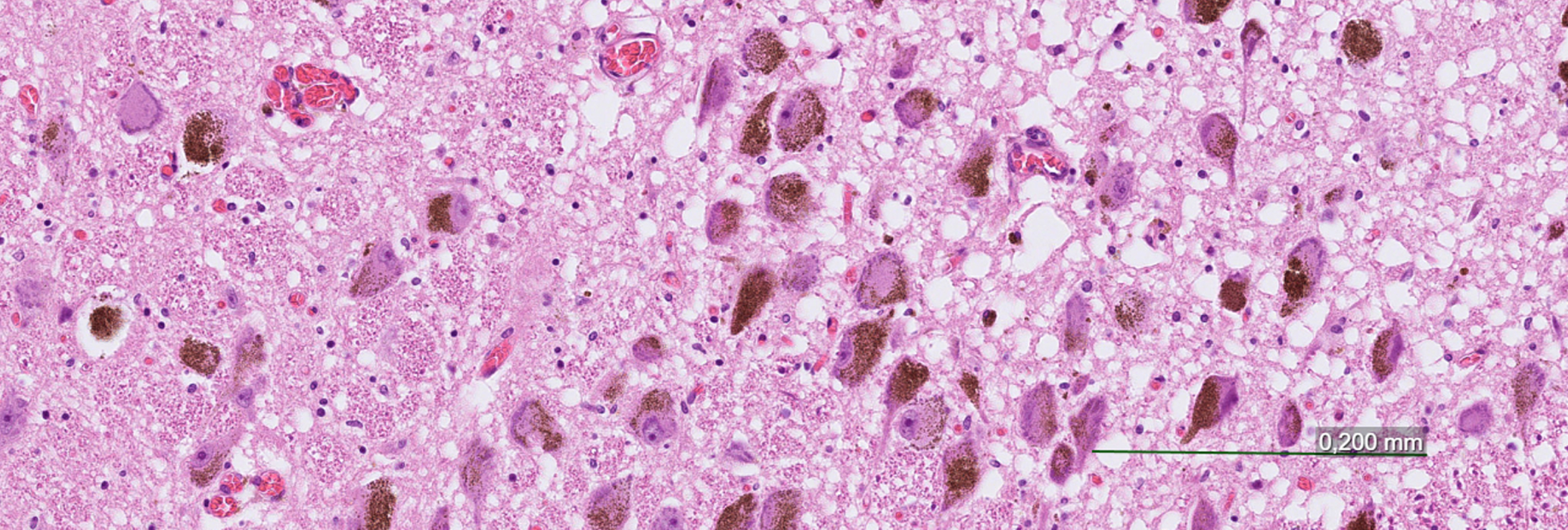 Example image of the locus coeruleus (LC) in neuropathological case diagnosed with frontotemporal lobar degeneration (FTLD) with transactive response DNA-binding protein 43 (TDP) proteinopathy at 13x magnification. Demonstrated in the image is the LC with a degeneration score 2 of 9 points possible according to the assessment tool introduced in the study. Scale bar representing 0.2 mm.