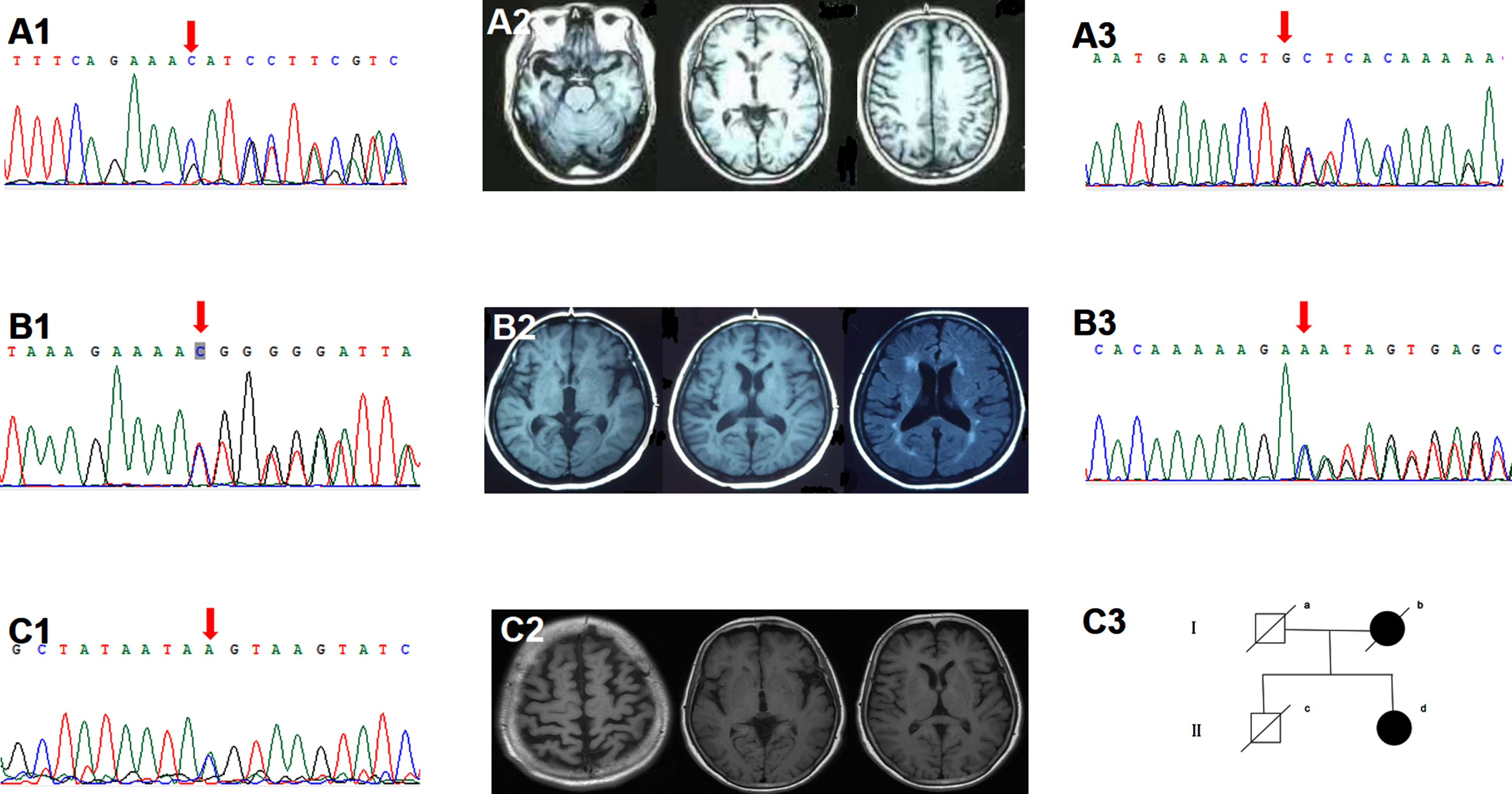 Clinical data of the TBK1 variant carriers. A1-2) Sanger sequencing indicated the TBK1 p.K622fs (c.1866_1872del) mutation. Brain MRI showed right temporal predominant atrophy. B1-2) Sanger sequencing indicated the TBK1 p.T31fs (c.92delC). Brain MRI showed left temporal predominant atrophy with periventricular white matter hyperintensities, fazekas grade 2. A3, B3) Sanger sequencing indicated the TBK1 p.T457fs (c.1371_1372del), p.T462fs (c.1385_1388del). C1-3) Sanger sequencing indicated the TBK1 p.T331N (c.992C>A) mutation. Brain MRI showed bilateral frontal and parietal atrophy with mild left insular atrophy. II-d was the index patient. Her mother developed cognitive decline in her 80s and died ten years later. Her father died at 70 without cognitive impairment. Her cognitively healthy brother had a sudden death at 60.