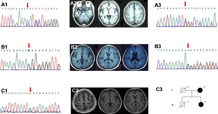 Clinical data of the TBK1 variant carriers. A1-2) Sanger sequencing indicated the TBK1 p.K622fs (c.1866_1872del) mutation. Brain MRI showed right temporal predominant atrophy. B1-2) Sanger sequencing indicated the TBK1 p.T31fs (c.92delC). Brain MRI showed left temporal predominant atrophy with periventricular white matter hyperintensities, fazekas grade 2. A3, B3) Sanger sequencing indicated the TBK1 p.T457fs (c.1371_1372del), p.T462fs (c.1385_1388del). C1-3) Sanger sequencing indicated the TBK1 p.T331N (c.992C>A) mutation. Brain MRI showed bilateral frontal and parietal atrophy with mild left insular atrophy. II-d was the index patient. Her mother developed cognitive decline in her 80s and died ten years later. Her father died at 70 without cognitive impairment. Her cognitively healthy brother had a sudden death at 60.