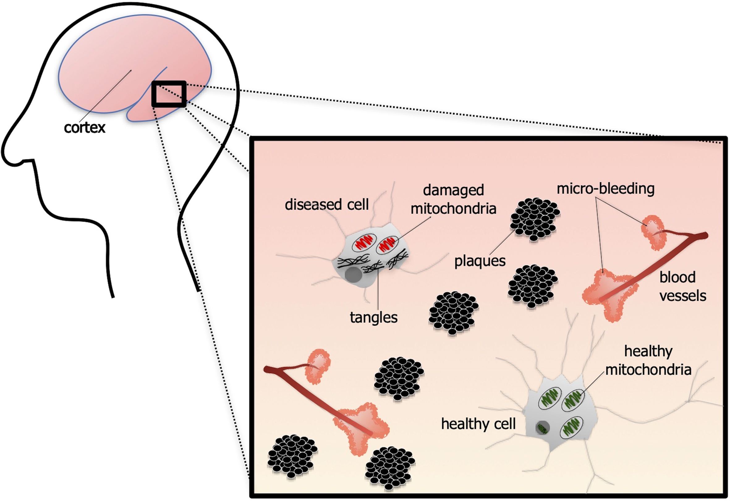 Schematic diagram of the pathology associated with alzheimer’s disease. The brain is characterized by neurons containing intracellular neurofibrillary tangles, made up of tau protein. The mitochondria are damaged and neurons become dysfunctional. There are also many extracellular aggregations of amyloid-ß plaques. Finally, there is much vascular pathology, with many sites of micro-bleeding across the brain. Note that, although not depicted here, the majority of the plaques found across the brain are associated with sites of micro-bleeding.