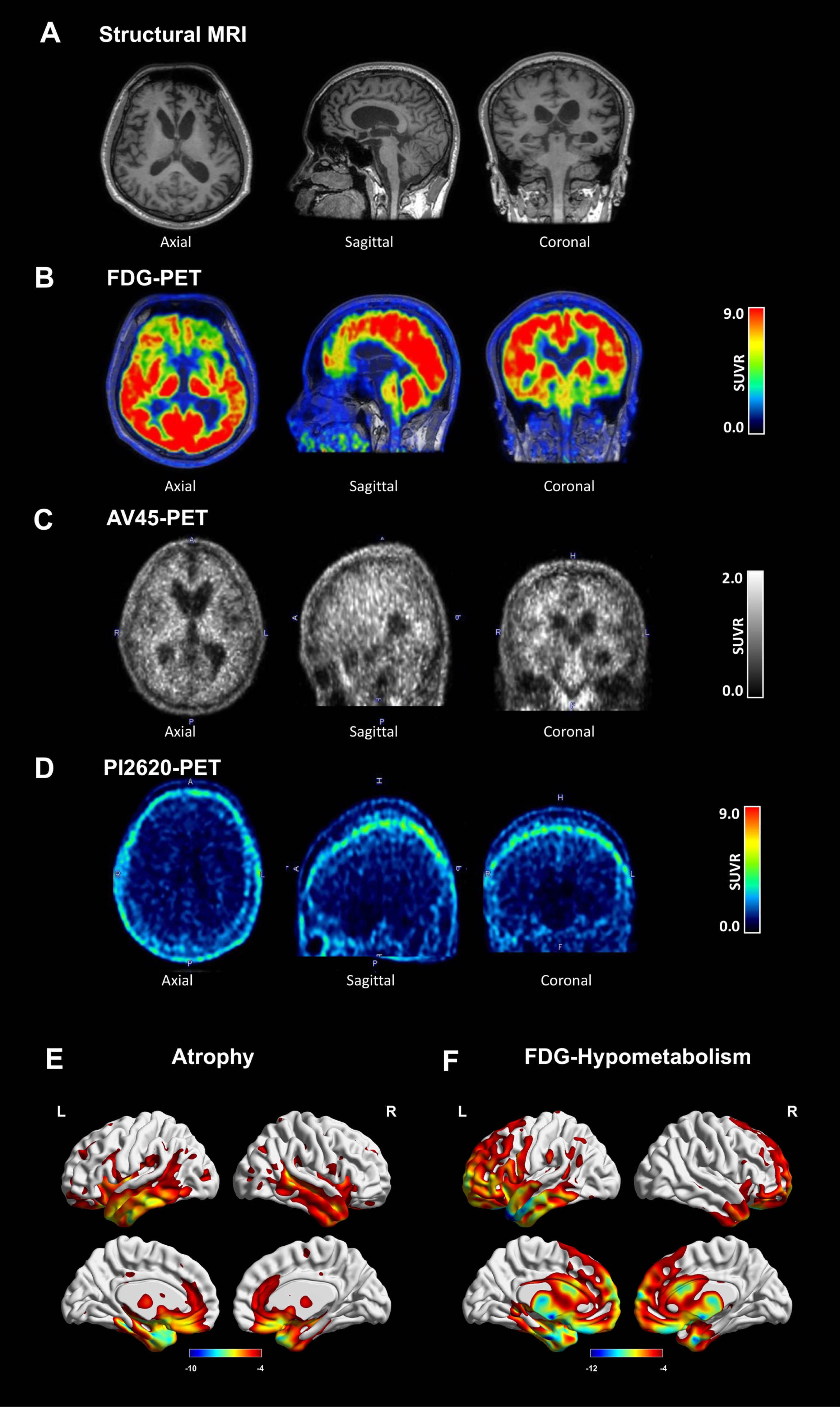 Neuroimages of the patient. Axial, sagittal, and coronal images of (A) structural MRI, (B) FDG-PET, (C) AV45-PET, and (D) PI2620 PET. (E) Atrophy and (F) Hypometabolism patterns in the patient in comparison with healthy controls. Detailed radiological Montreal Neurosciences Institution (MNI) coordinates of the clusters are shown in Table 1.