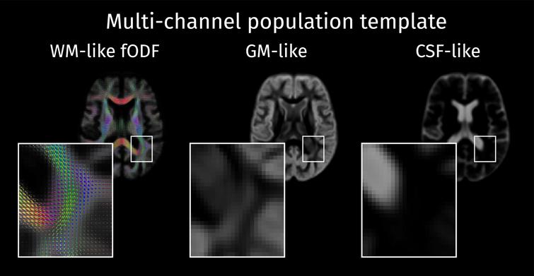 The study-specific population template is composed of a white matter fiber orientation distribution function (WM fODF) template along with the voxel-wise templates containing the tissue-like contributions for GM and CSF.