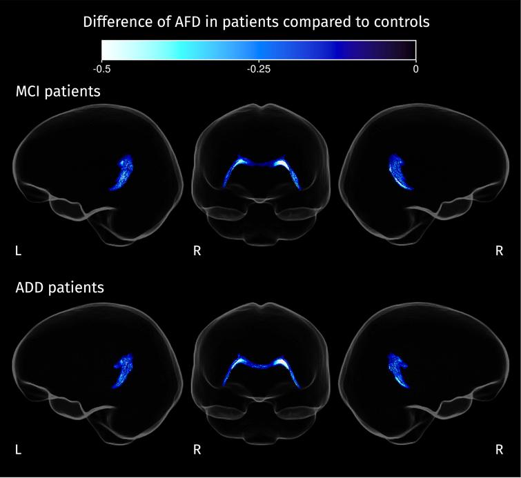 Section of the corpus callosum where AFD is significantly reduced in both groups of patients compared to control subjects (strong FWE-corrected p < 0.05). Color corresponds to the value of the difference between the mean AFD for patients and the mean AFD for controls.