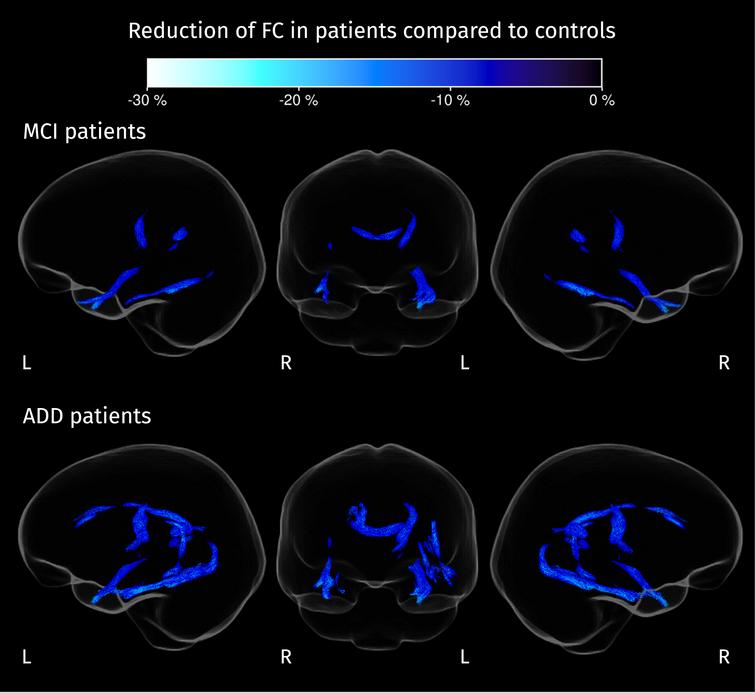 Streamline segments corresponding to fixels where FC is significantly reduced in patients compared to controls (strong FWE-corrected p < 0.05). Color corresponds to the percentage of change in each group of patients compared with the control group.