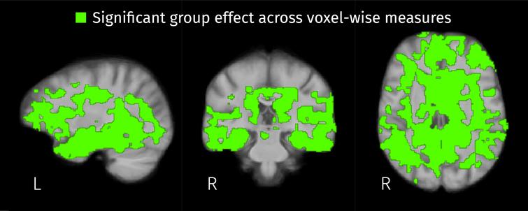 Brain areas where the disease stage has a significant effect on any of the three voxel-wise measures: the two isometric log-ratios and the Jacobian determinant (FWE-corrected p < 0.05).