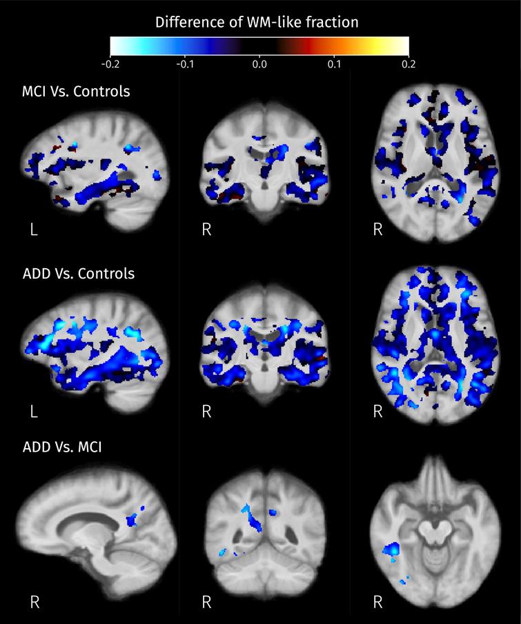 Differences of mean WM-like fraction in brain areas where at least one of isometric log-ratios is significantly different (strong FWE-corrected p < 0.05) between pairs of groups.
