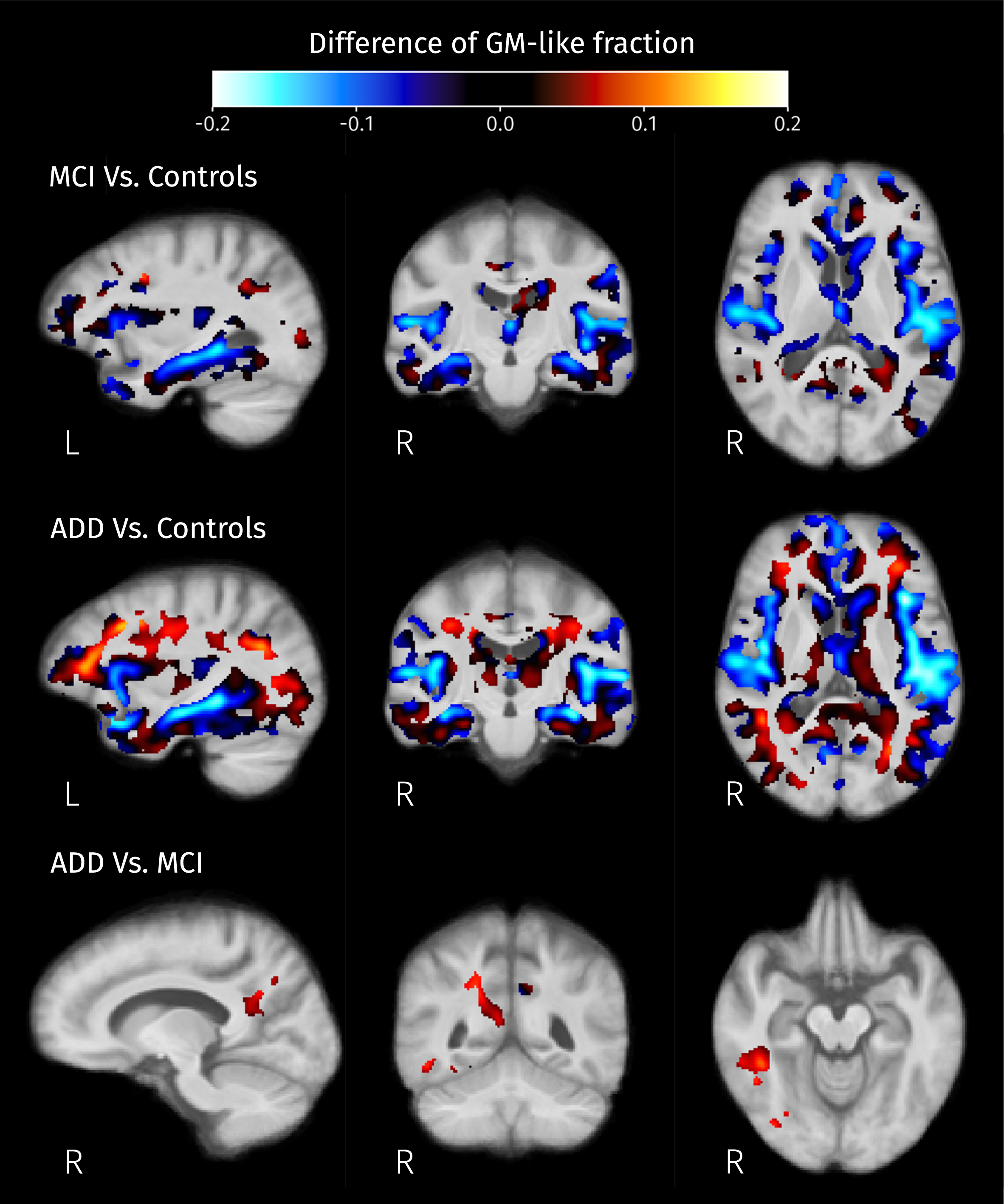 Differences of mean GM-like fraction in brain areas where at least one of isometric log-ratios is significantly different (strong FWE-corrected p < 0.05) between pairs of groups.