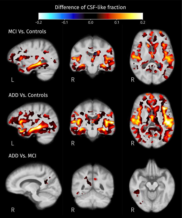 Differences of mean CSF-like fraction in brain areas where at least one of isometric log-ratios is significantly different (strong FWE-corrected p < 0.05) between pairs of groups.