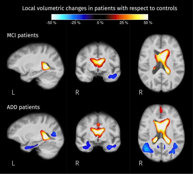 Brain areas where the Jacobian determinant is significantly different (strong FWE-corrected p < 0.05) in patients compared to controls. The colormap represents the percentage of change in local volume compared to the control group. Analogous to FC, analyses for this value were performed in the log domain therefore this percentage of change was calculated as exp(βPT) – 1 where βPT represents the difference between the mean value of the logarithm of the Jacobian determinant for MCI/AD patients and the mean of those values for controls.