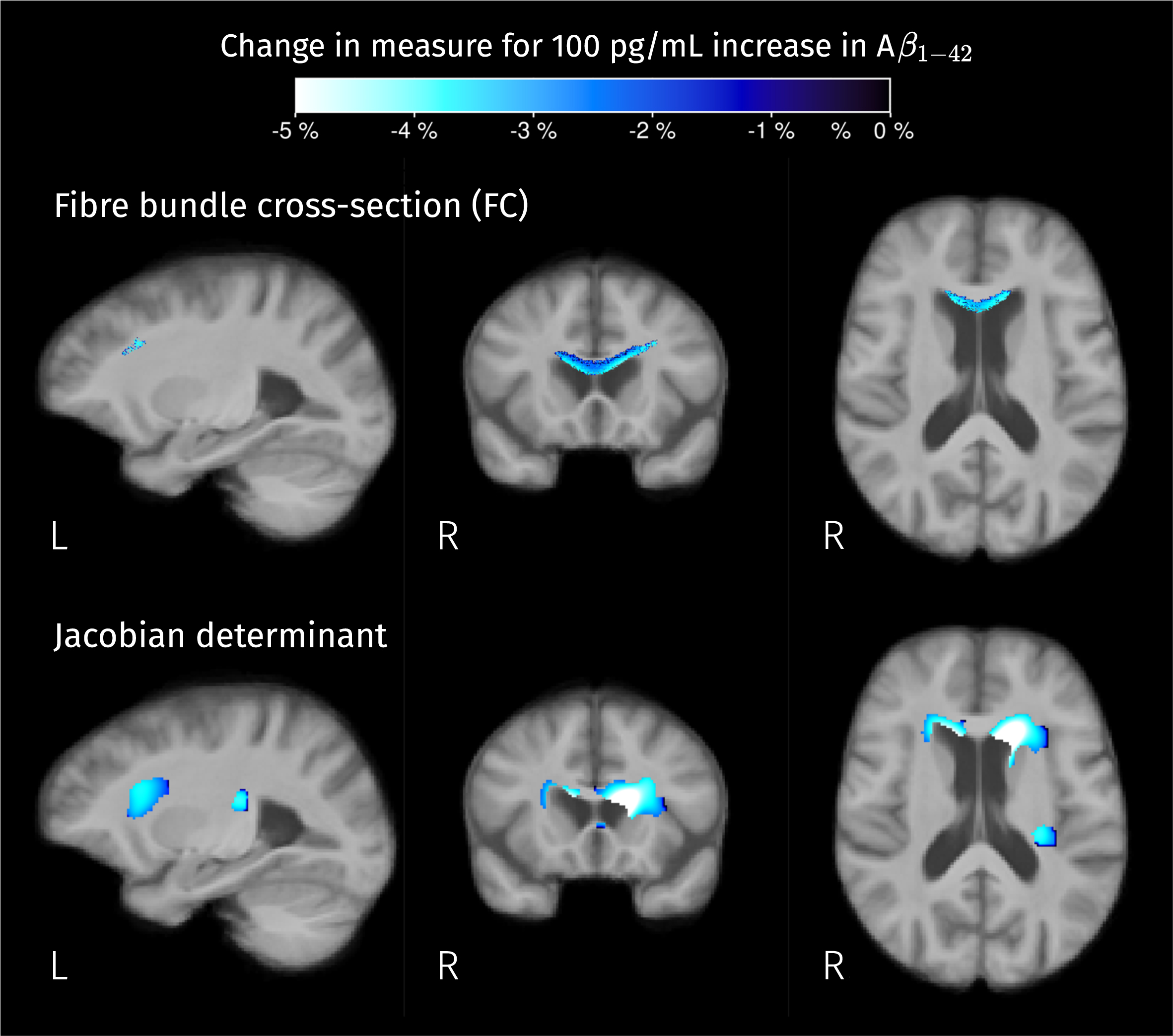 Brain areas where there is a significant linear relation between CSF biomarker for Aβ1–42 and measures of macroscopic change relative to the population template. Color corresponds to the percentage of change in these measures for a 100 pg/mL increase in biomarker value. Given that analyses for fiber cross-section and Jacobian determinant were performed in the log scale, the color-coded effects in significant areas were calculated as exp(β×100) – 1 where β is the GLM coefficient of Aβ1–42 for the corresponding measure.