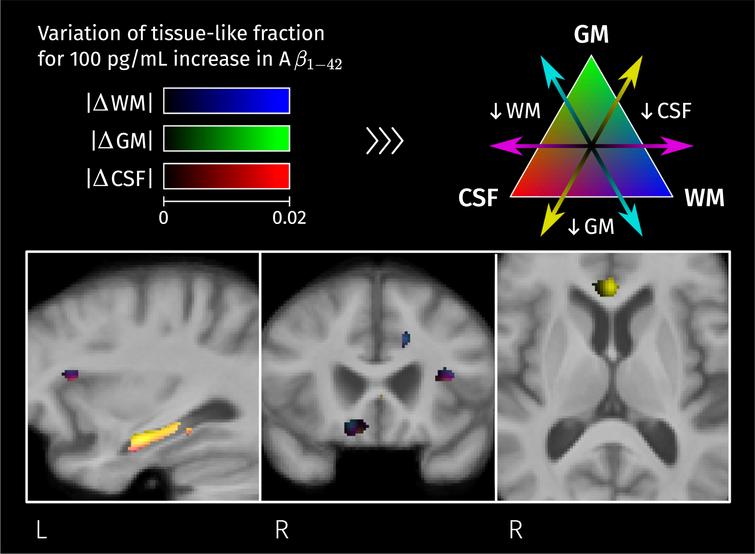 Significant linear relation between CSF biomarker for Aβ1–42 and the second isometric log-ratio was found in the left hippocampus. Colormap represents the estimated GLM coefficient of Aβ1–42 (multiplied by 100) for the GM-like and CSF-like fractions.