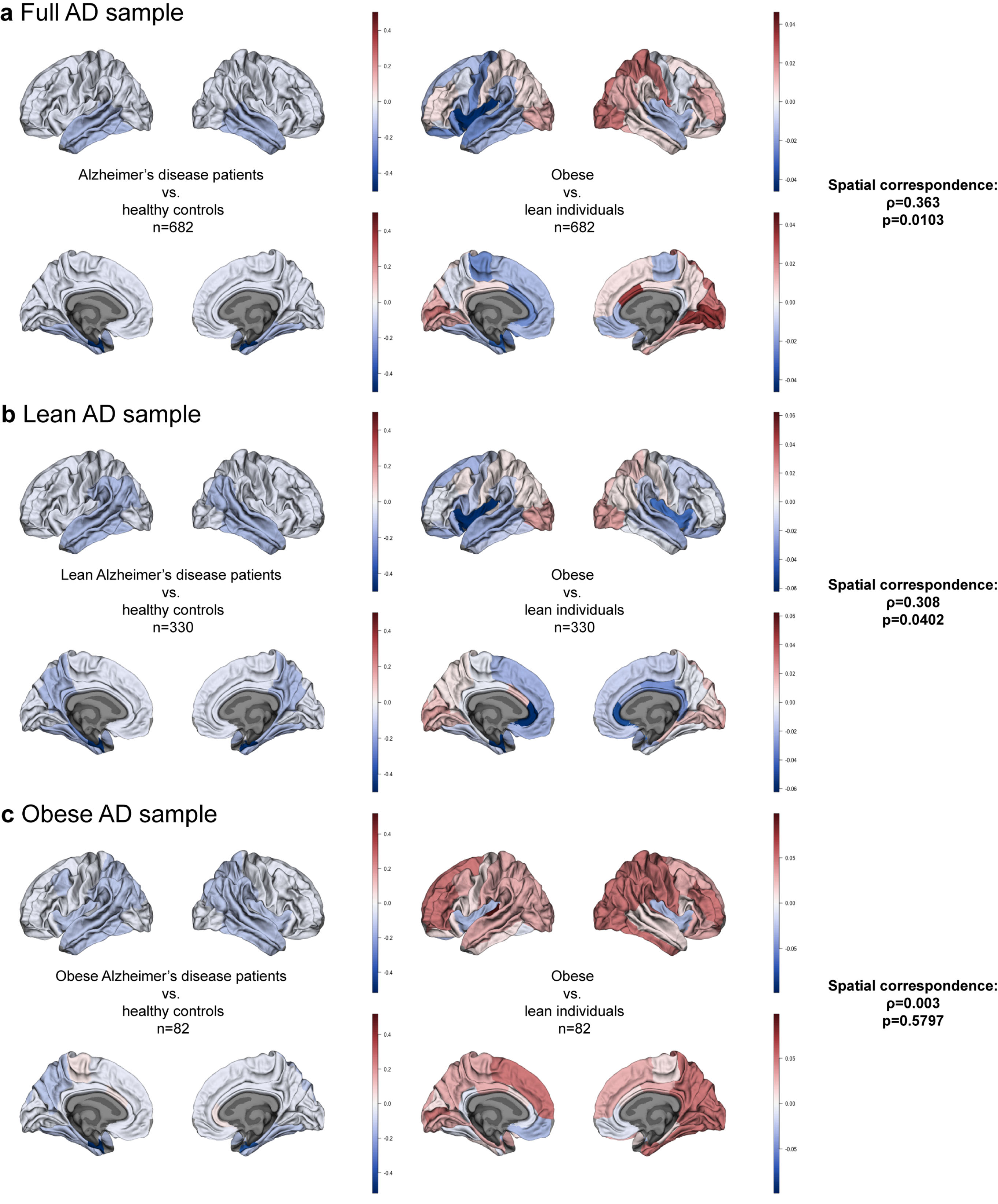 Brain maps of a) Alzheimer’s disease (AD) and obesity in the full sample; b) AD and obesity in the sample of lean AD patients and other matched samples; c) AD and obesity in the sample of obese AD patients and other matched samples. Color bars depict β estimates.