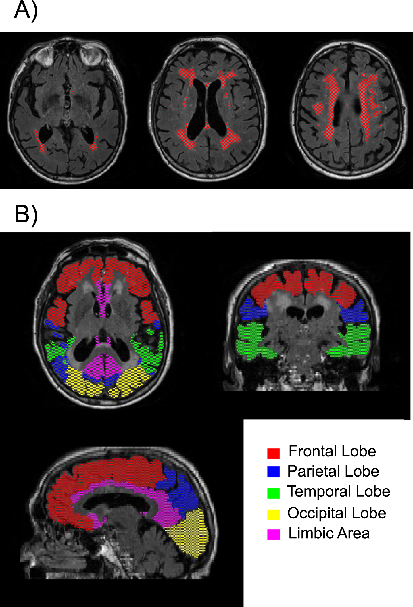 Example of A) segmented white matter hyperintensities are shown in red on three different axial slices; and B) the five regions of interest examined are shown in different colors.