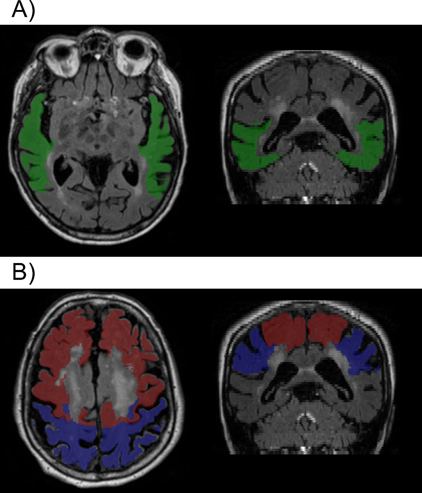 Example of segmentation showing A) the temporal region (green) where higher WMH volumes were associated with higher levels of p-tau and t-tau; and B) parietal (blue) and frontal (red) regions, where greater WMH volumes where associated with higher summary vascular risk scores (see text for details).