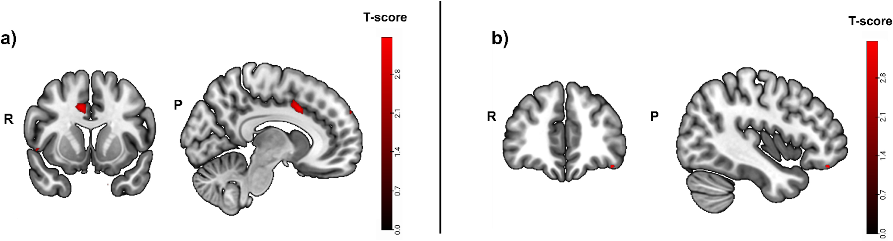 Greater activity related to greater hippocampal atrophy in the episodic memory task (cued recall > control contrast, puncorrected < 0.01), used as mask. Activity was detected in the left temporal pole and the right middle cingulate and occipital fusiform gyrus. b) Greater activity related to high episodic memory task accuracy in the cued recall > control contrast was located in the left lateral orbital gyrus and the left cerebral white matter/occipital fusiform gyrus (puncorrected < 0.001, before masking). R, right; P, posterior.