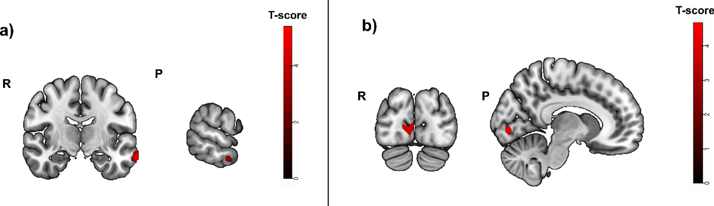 Greater activity related to greater hippocampal atrophy in the episodic memory task (cued recall > control contrast, puncorrected < 0.01), used as mask in a subsample with positive blood biomarkers for amyloid positivity. Activity was detected in the left middle temporal gyrus, the right angular gyrus and left cerebral white mater/temporal pole. b) Greater activity related to high episodic memory task accuracy (cued recall > control contrast, before masking) was located in the right calcarine cortex, the left middle frontal gyrus, the left cerebral white matter and opercular part of the inferior frontal gyrus. R, right; P, posterior.