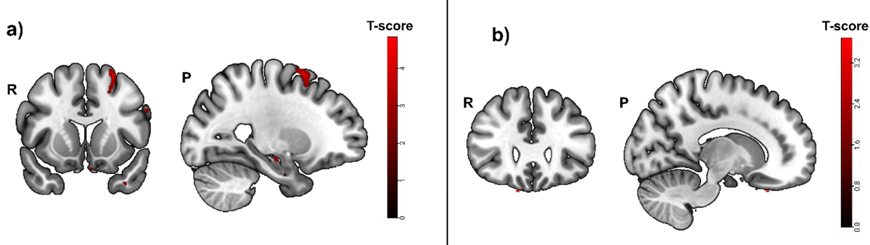 Greater activity related to greater hippocampal atrophy in the spatial abilities task ([translation+rotation]>luminance conditions contrast, puncorrected < 0.01), used as mask in a subsample with positive blood biomarkers for amyloid positivity. Activity was detected in the left middle frontal gyrus, the left superior frontal gyrus and the left superior frontal gyrus medial segment. b) Greater activity related to high spatial abilities task accuracy (before masking) was located in the right medial orbital gyrus and the gyrus rectus (puncorrected < 0.001).