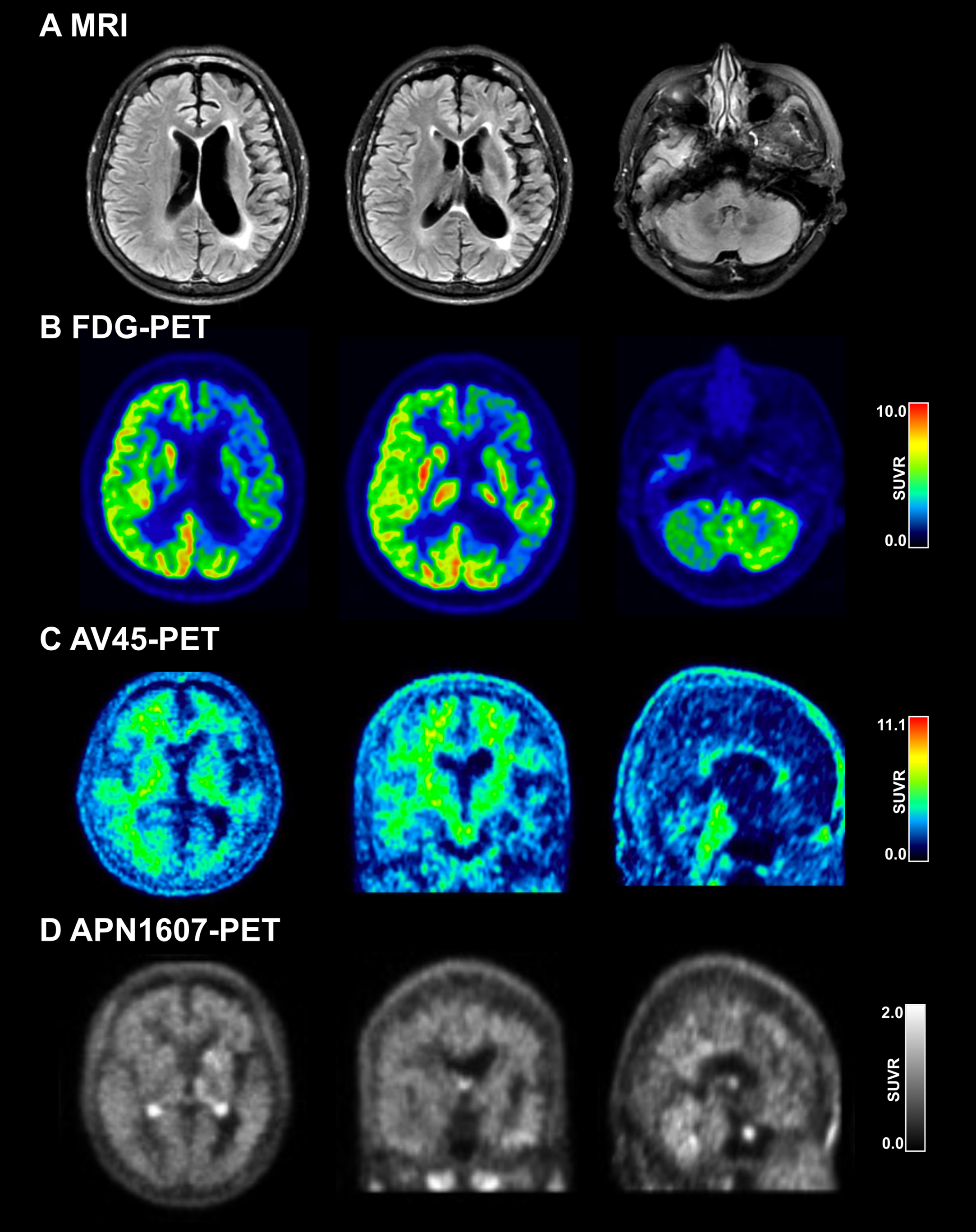 Neuroimaging of the patient with GRN mutation. A) MRI showing left-side atrophy in the frontal, temporal, and parietal lobes. B) FDG-PET showing left-side hypometabolism in the frontal, temporal, and parietal lobes. C) AV45-PET showing absence of Aβ deposition. D) APN1607 PET showing absence of tau deposition.