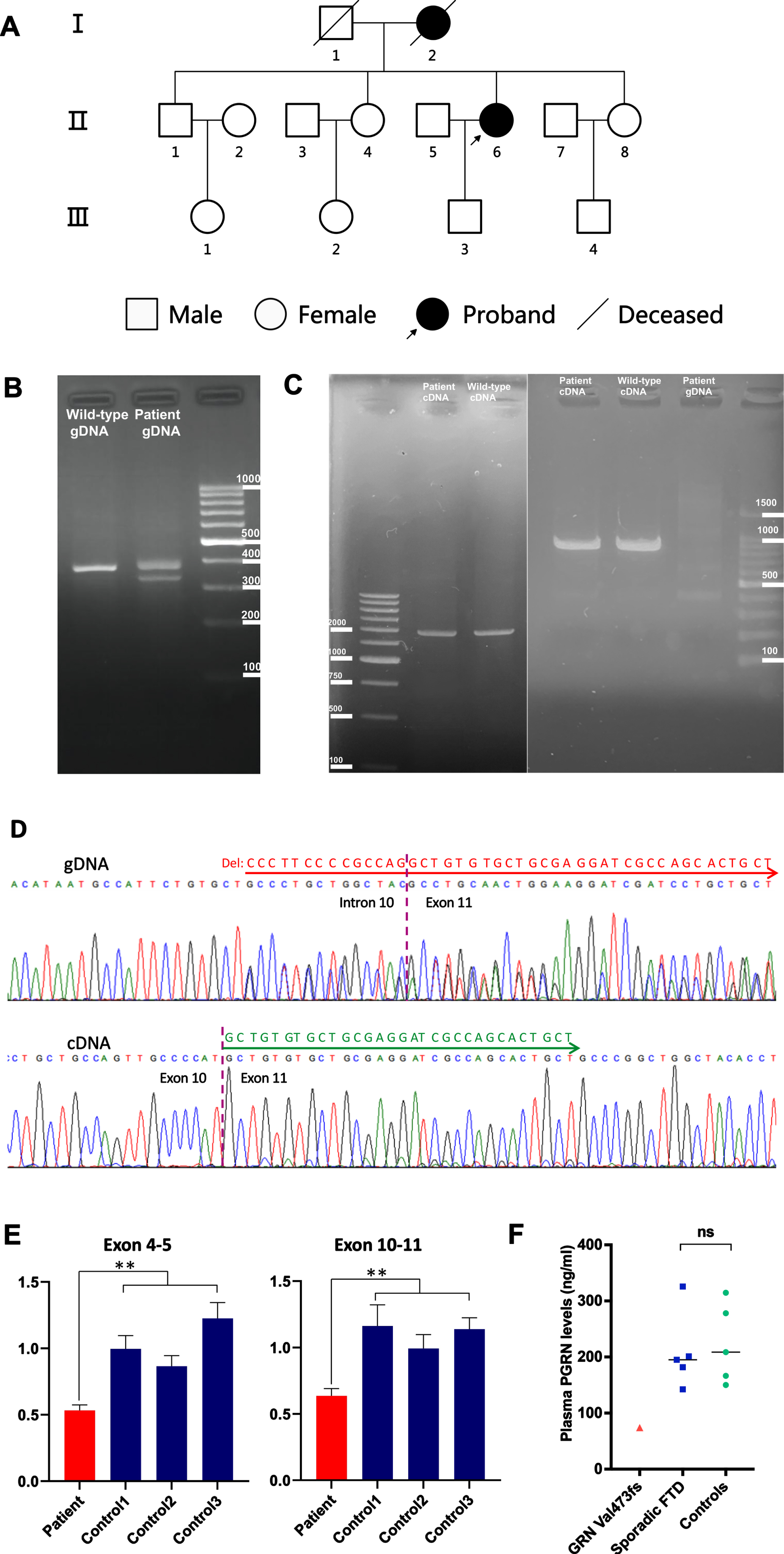Genetic analysis of the GRN gene. A) Pedigree of the patient with GRN mutation. B) PCR amplification products across the deletion at the intron 10/exon 11 boundary of GRN from the patient and a wild-type control were examined by agarose gel electrophoresis. The 367-bp band corresponds to the wild-type allele. A 322-bp fragment corresponding to the heterozygous mutated allele with the 45-bp deletion was amplified from the gDNA of the patient. C) Left panel: Agarose gel electrophoresis of the long-range RT-PCR products revealing only the 2081-bp cDNA fragment corresponding to the predicted canonical transcripts in both the patient and control subject. Right panel: Agarose gel electrophoresis of shorter RT-PCR products showing only the 1071-bp band expected in both the patient and control. cDNA, complementary DNA; gDNA, genomic DNA. D) Upper lane: Sequence analysis of the gDNA PCR product of the patient revealed a c.1414-14_1444delCCCTTCCCCGCCAGGCTGTGTGCTGCGAGGATCGCCAGCACTGCT mutation in heterozygous state. Lower lane: Sanger sequencing of the RT-PCR products of the patient revealed the canonical transcripts. We found a substantial reduction in the amount of mutant allele which is virtually absent. E) GRN gene expression was analyzed by qRT-PCR using total RNA extracted from peripheral leukocytes of the patient with primer sets corresponding to sequences within exons 4–5 (left panel) and exons 10–11 (right panel). A –∼50% decrease in the GRN product (normalized to RPS17 level) was observed in the patient compared with the same product in the 3 wild-type control subjects. Data are expressed as Mean±SD of 3 independent experiments. **p < 0.01 (Mann–Whitney U test). F) Plasma PGRN levels (ng/ml) in the patient carrying the GRN Val473fs mutation (red triangle), 5 FTD patients without GRN mutations (blue squares), and 5 healthy control subjects (green circles). Each data point represents an individual. Black horizontal lines indicate the median plasma PGRN levels of FTD patients without GRN mutations and healthy controls.