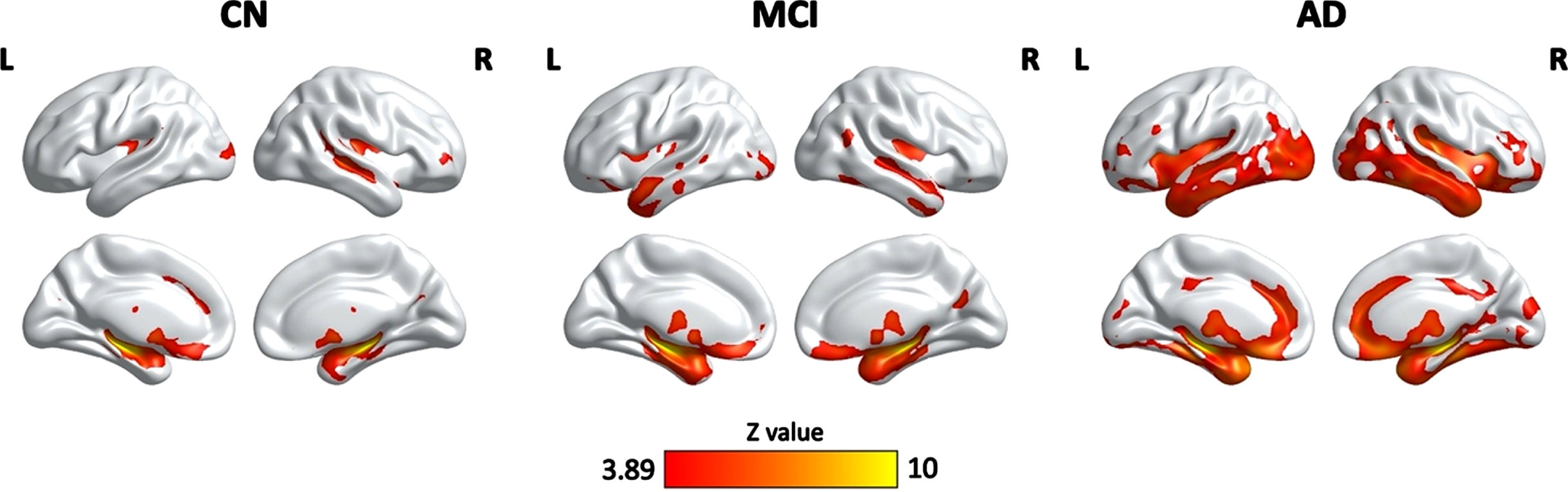 Clusters showing significant associations between the HPF and cortical grey matter volume, controlling for age, quadratic age, gender, scanning protocol, and TIV. The resulting clusters were corrected for multiple comparisons (Z > 3.89, GRF corrected). L, left; R, right; CN, cognitively normal; MCI, mild cognitive impairment; AD, Alzheimer’s disease.