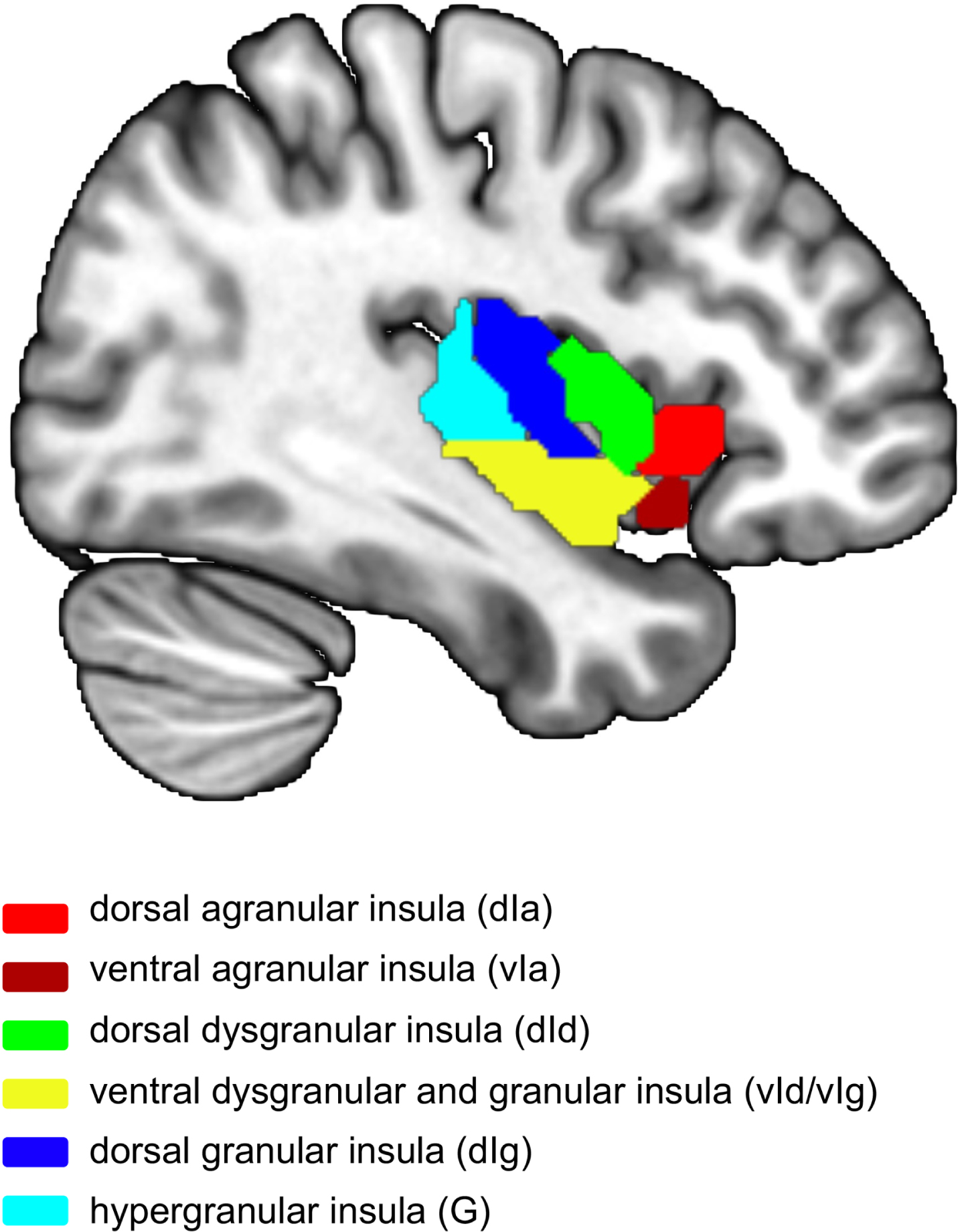 Atlas of insula subregions (left side). ROIs were selected based on the Human Brainnetome Atlas [18], which divided the insula into 6 subregions. Different colors represent different insula subregions. Red, dorsal agranular insula (dIa); dark red, ventral agranular insula (vIa); green, dorsal dysgranular insula; yellow, ventral dysgranular and granular insula (vId/vIg); dark blue, dorsal granular insula (dIg); light blue, hypergranular insula (G).