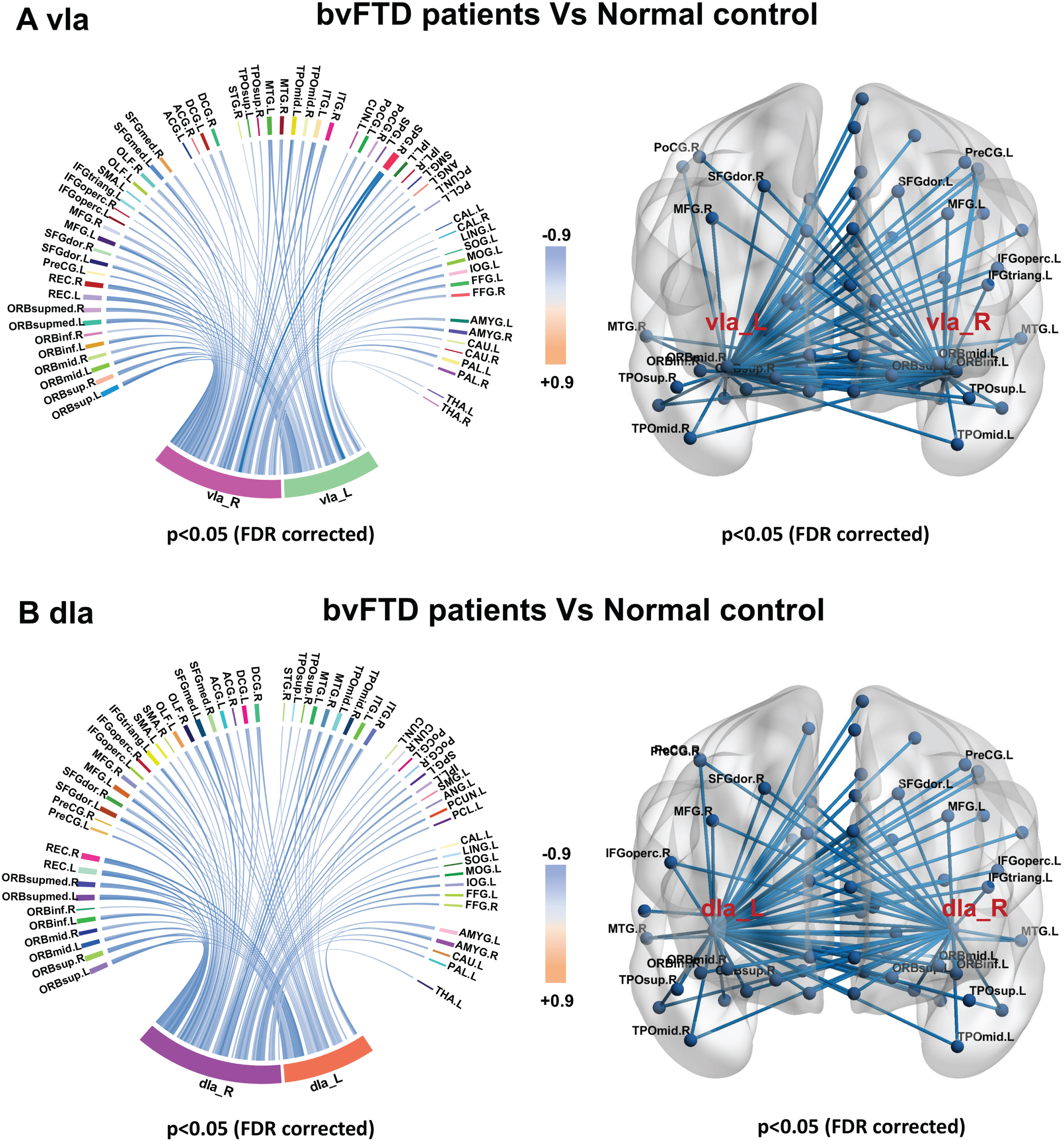 Sub-insula metabolic network in bvFTD and control groups. Compared with controls, bvFTD patients showed decreased metabolic connectivity between bilateral vIa (A) and dIa subregions (B) and frontal, temporal, parietal, and occipital poles; basal ganglia; and thalamus.