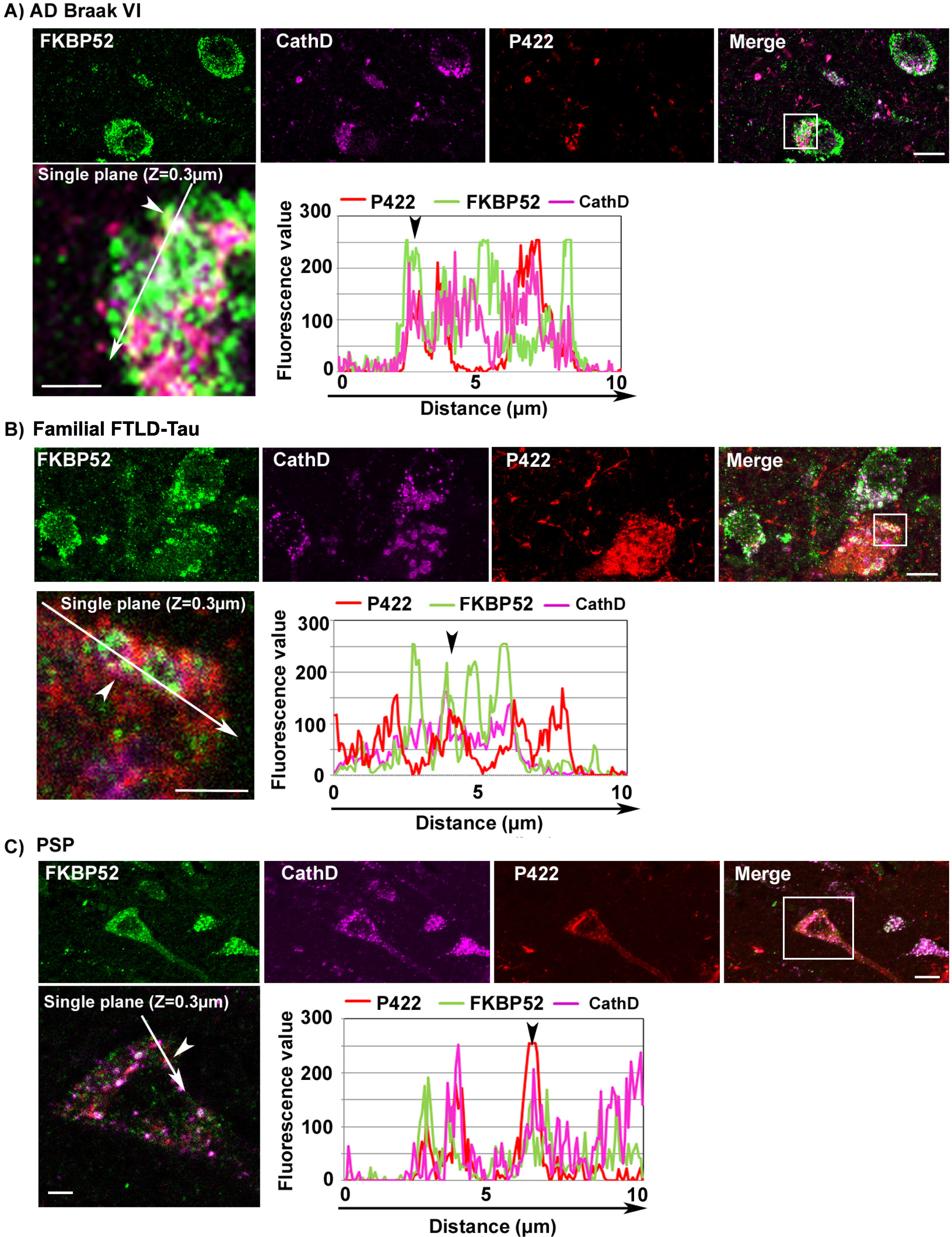 Triple labeling experiments showing the lysosomal colocalization of FKBP52 and the early pathologic Tau-pS422 isoform in frontal cortex neurons of patients with different tauopathies. Triple labeling experiments of familial FTLD-Tau (A), AD Braak VI (B), and PSP (C) frontal cortex sections respectively: FKBP52 (green) and Tau-pS422 (red) colocalize (merge) with the endolysosomal marker Cathepsin D in the three tauopathies. Scale bar 10μm. At the lower right of each set of micrographs: superposition of the three respective single plane fluorescence profiles of a single neuron (lower left, scale bar 3μm).