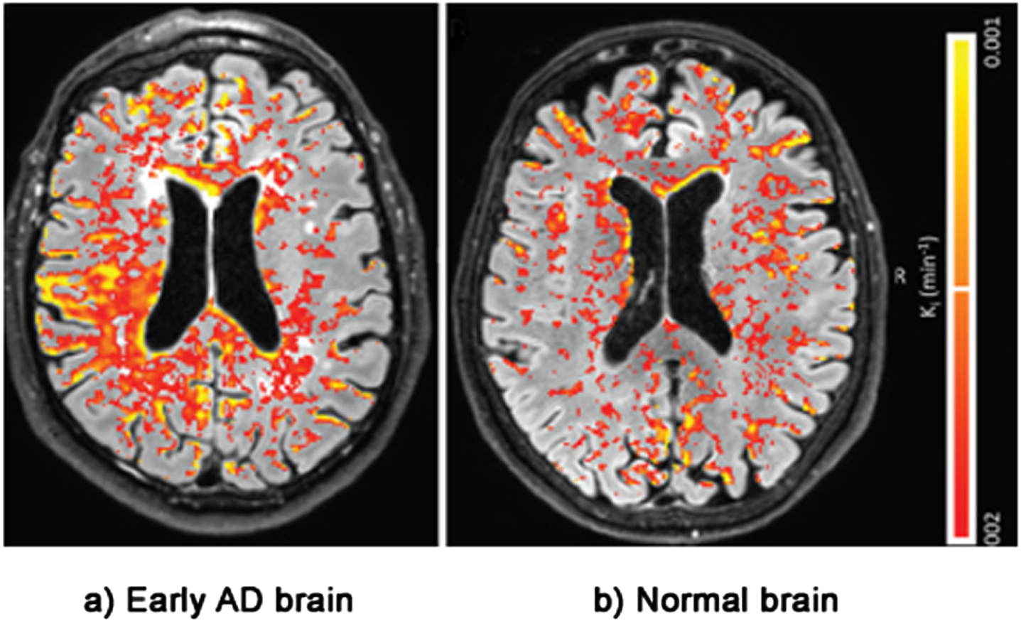 Evidence of BBB damage in the AD brain: (a) extensive leakage of gadobutrol (an MRI contrasting agent) through a damaged BBB in brains of patients with early signs of AD; (b) less extensive leakage of the agent in brains of normal patients. Used with permission of The Radiological Society of North America, from van de Haar HJ, Burgmans S, Jansen JFA, van Osch MJP, van Buchem MA, Muller M, Hofman PAM, Verhey FRJ, Backes WH, Blood-brain barrier leakage in patients with early Alzheimer disease, Radiology (2016) 281, 527–535.