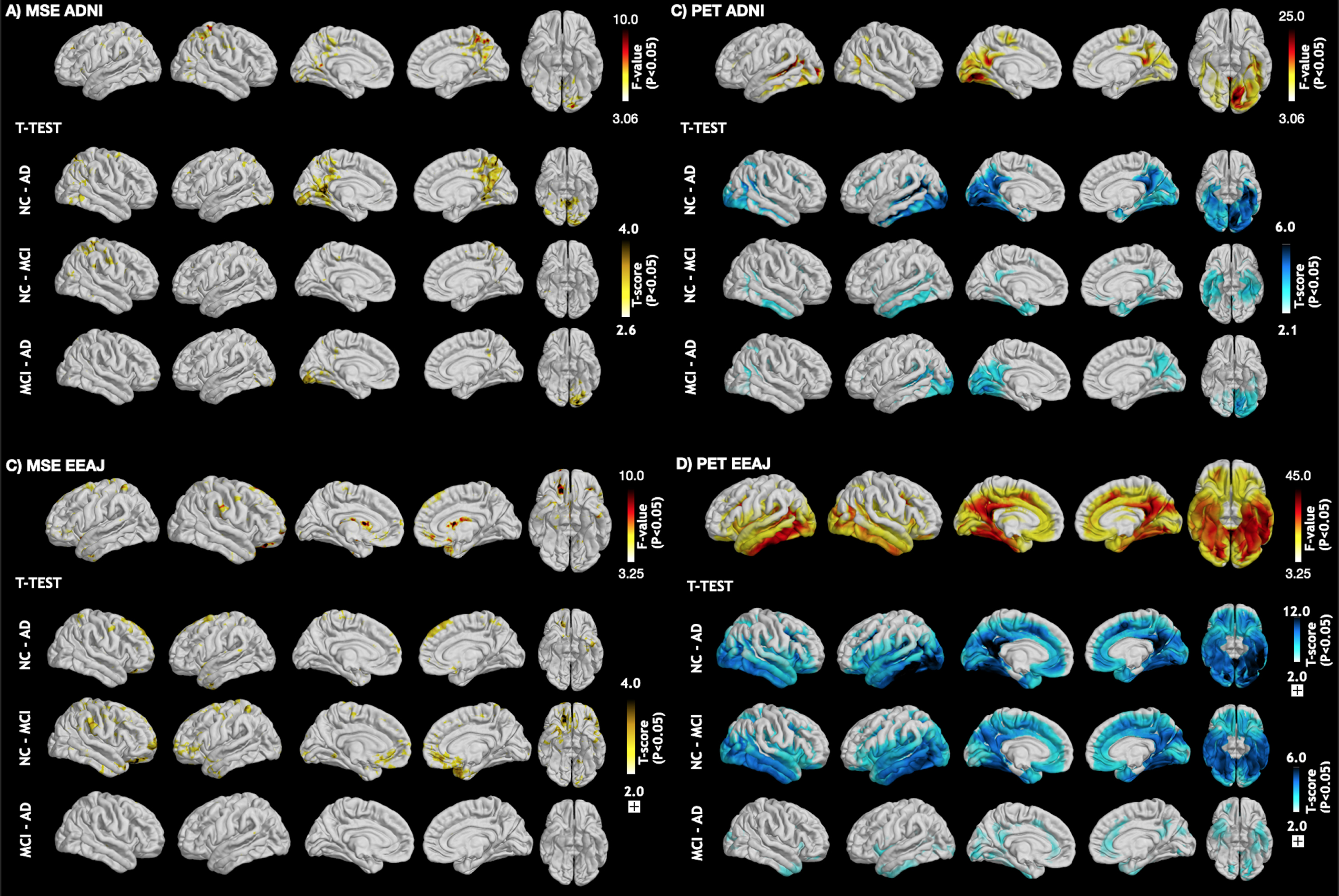 ANOVA and post-hoc t-test maps comparing (A + B) MSE and (C + D) the tau-PET SUVR values across the three groups (CN, MCI, AD) in each cohort. CN, cognitively normal; MCI, mild cognitive impairment; AD, Alzheimer’s disease; MSE, multi-scale entropy.
