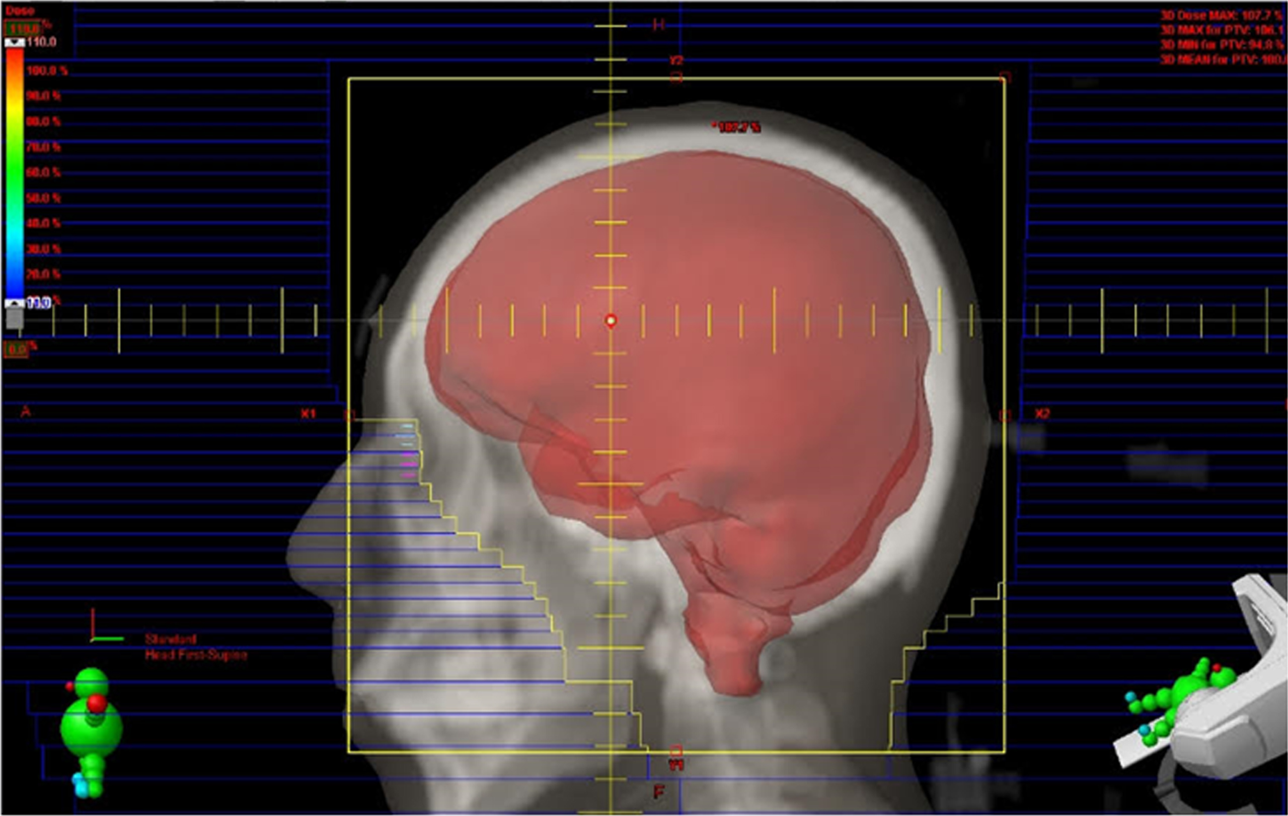 Target volumes for LDRT include the whole brain up to the C2 level to sufficiently cover the base of the skull.