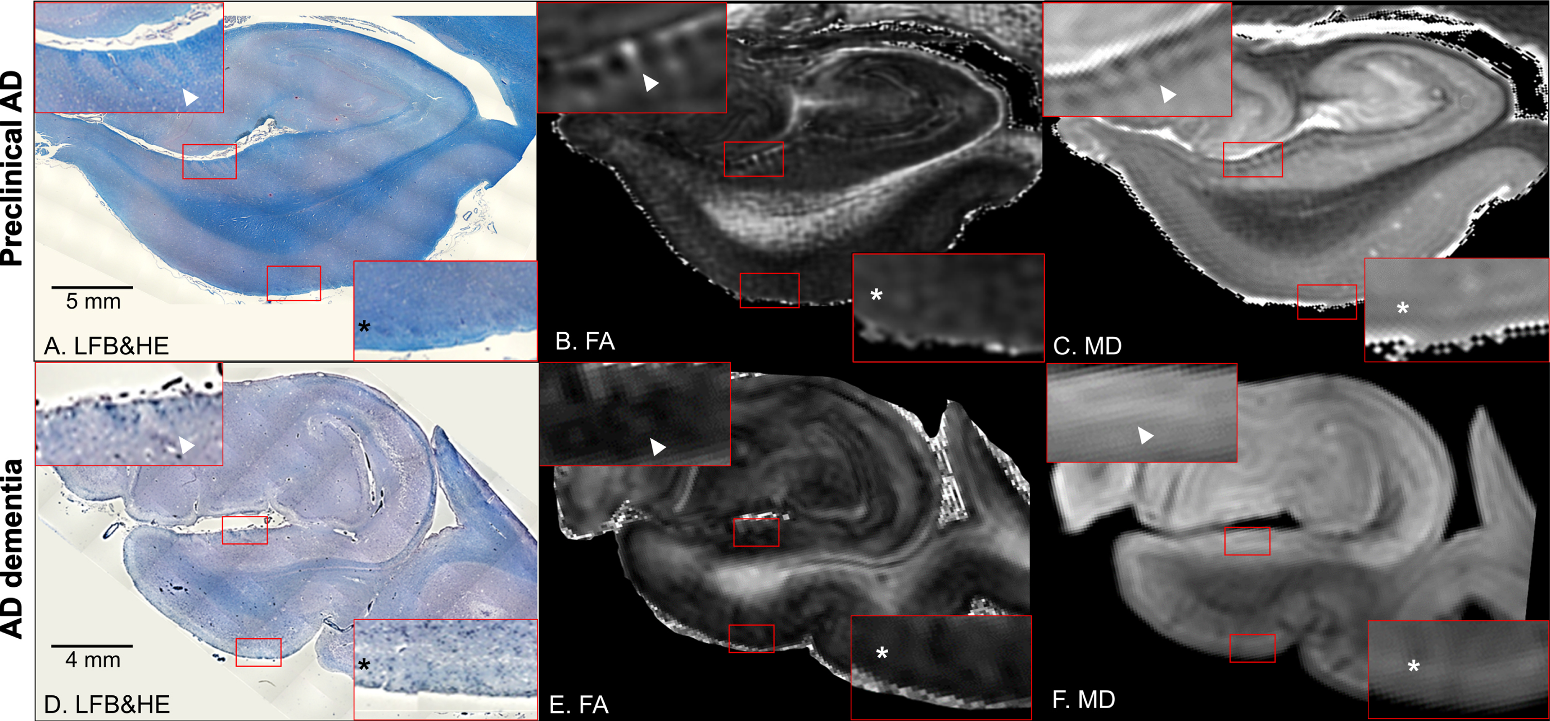 Coronal panels of the left entorhinal cortex in preclinical Alzheimer’s disease (AD) (A–C) and AD dementia brain tissues (D–F). A, D) Luxol fast blue with hematoxylin and eosin staining (LFB&HE). B, E) Fractional anisotropy (FA) maps. C, F) Mean diffusivity (MD) maps. The red bounding boxes are 5× magnified to clearly visualize the perforant path fibers on the presubiculum (left-upper panel) and the entorhinal layer II islands (right-lower panel). Arrowheads point to myelinated fibers in the presubiculum and asterisks denote the entorhinal layer II cortices (A–F). Note that these cortical substructures are not clearly discernible in the AD dementia brain tissue.