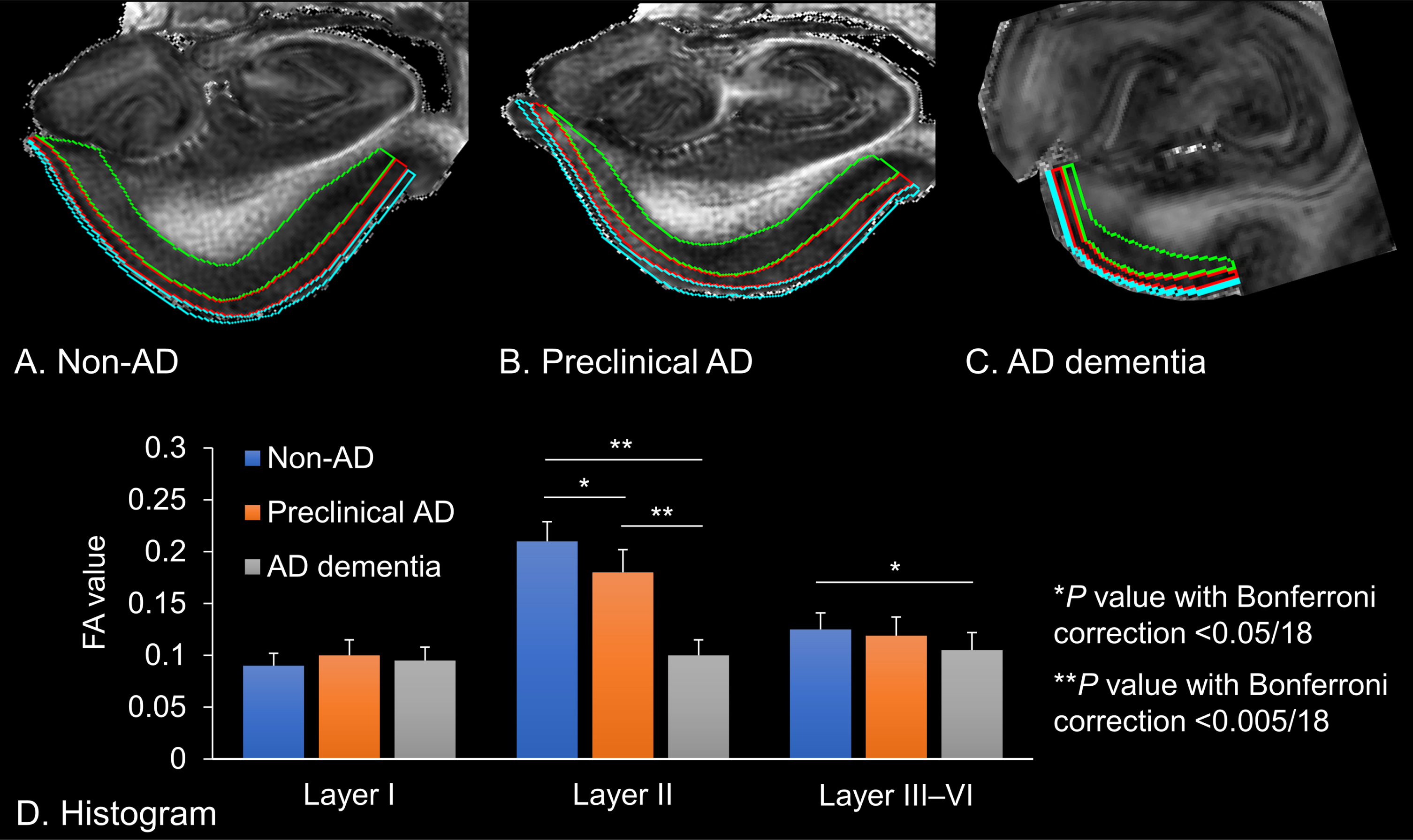 Fractional anisotropy (FA) values extracted from the left entorhinal cortices. A) Non-Alzheimer’s disease (AD) brain tissue, which is delineated for each entorhinal cortex. B) Preclinical AD brain tissue. C) AD dementia brain tissue. Cyan: Layer I, Red: Layer II, Green: Layer III–VI. D) The histogram shows the FA value of each entorhinal lamina. Error bars indicate standard error of the mean. Asterisks denote significant differences between the mean of the FA values (*p value with Bonferroni correction <0.05/18; **p value with Bonferroni correction <0.005/18).