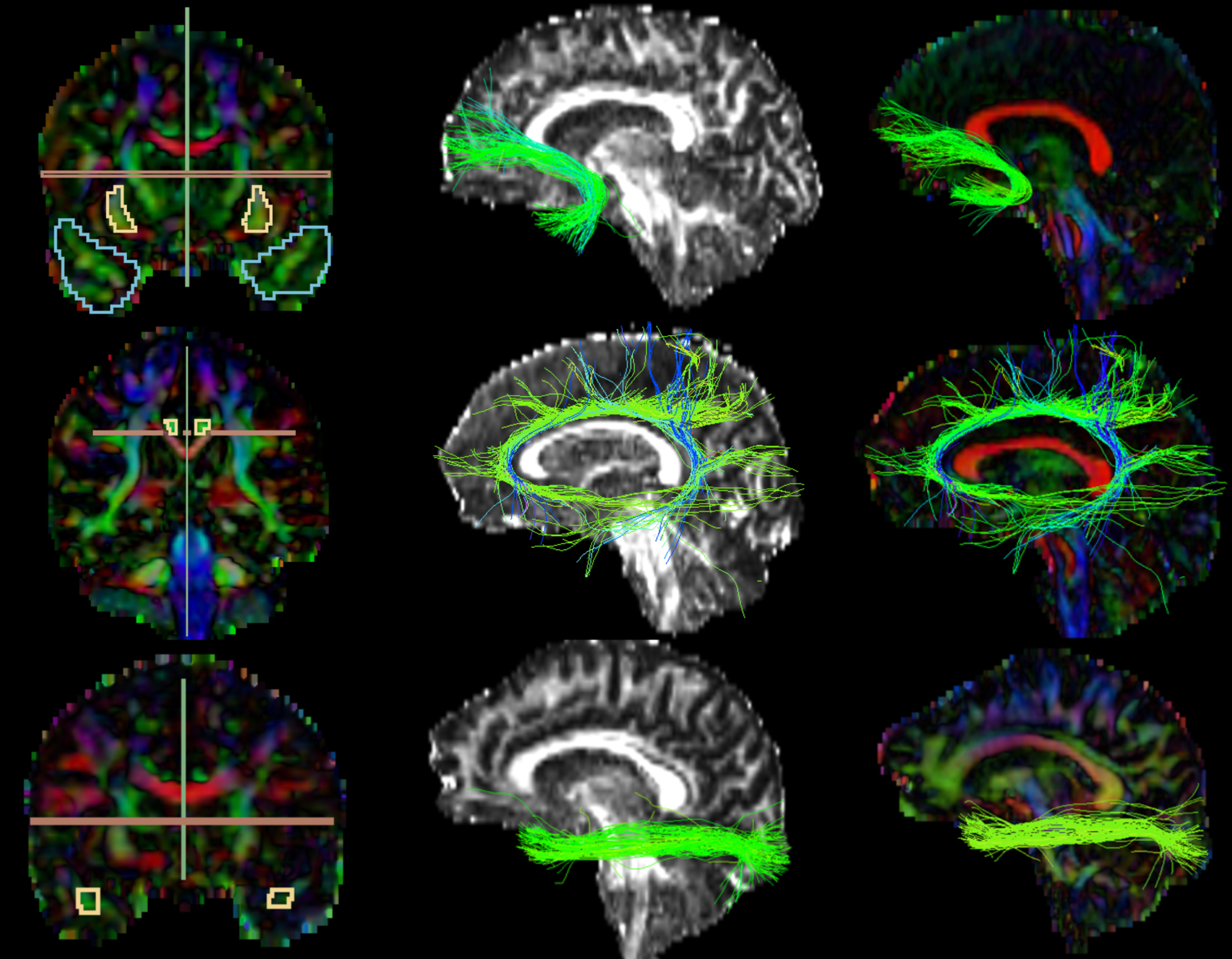 Extracted Tracts. The first images on the left column partially represent the manual drawings of the inclusion and exclusion areas; 1st row) Uncinate Fasciculus: blue (temporal area) and yellow (external capsule) inclusion, green and red exclusion; 2nd row) Cingulate: yellow inclusion, red and green exclusion; 3rd row) Inferior Longitudinal Fasciculus: yellow inclusion (temporal area; occipital not shown in the picture), green and red exclusion. The images on the second and third columns represent the extracted tracts shown over the FA and color-by-orientation maps, respectively.