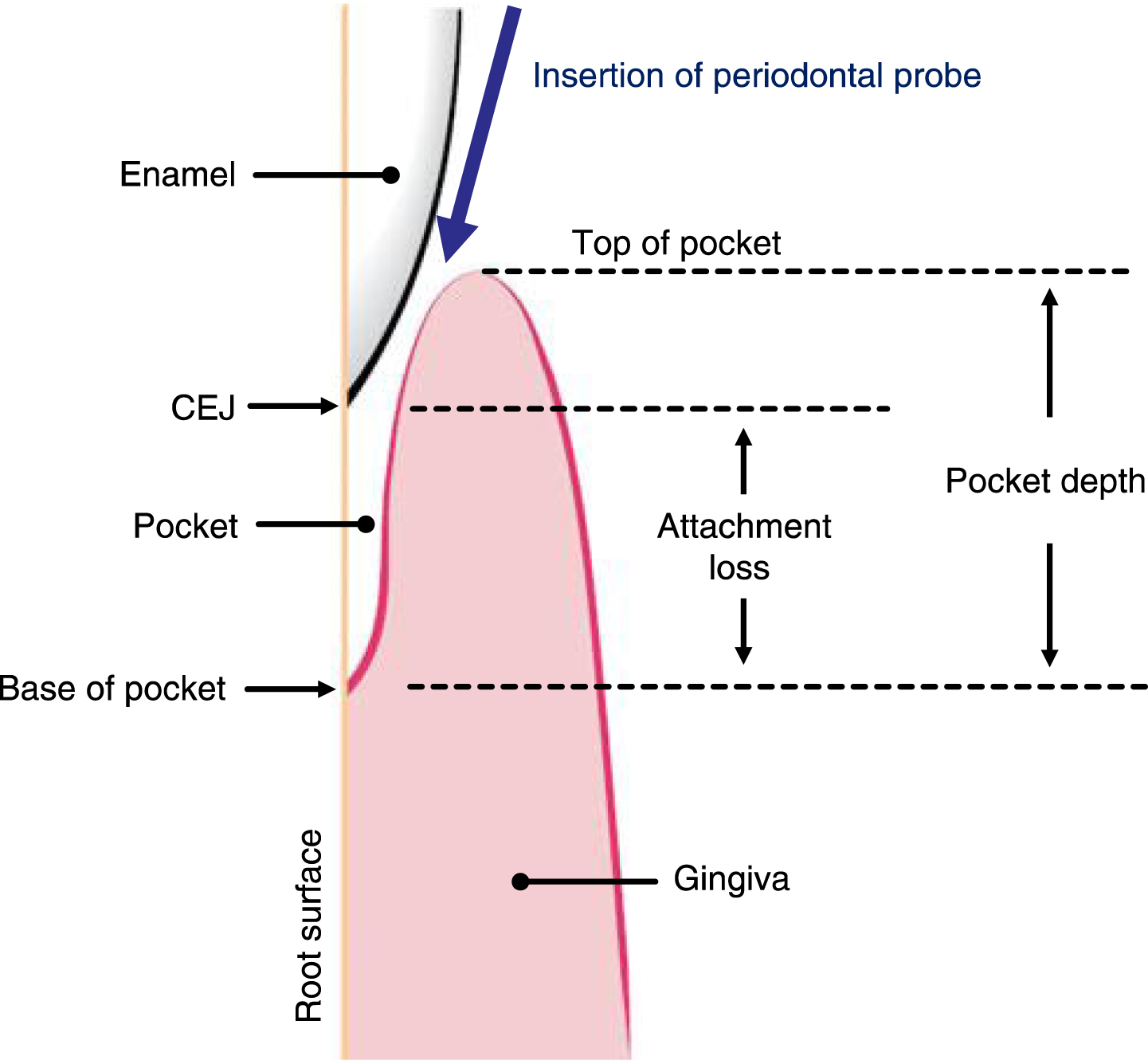 Diagram of clinical attachment loss and pocket depth in a patient with periodontal disease. This figure shows the schema of the clinical attachment loss and probing pocket depth, which indicate periodontal disease (PeD) [42]. The pocket is the space between the root surface and the gingiva. In PeD, the base of the pocket migrates apically, thereby creating a pocket. The base of the pocket is therefore apical to the cementoenamel junction (CEJ, the boundary between the enamel crown and the root), and attachment loss can be measured using a periodontal probe from the CEJ to the base of the pocket. Probing pocket depth is measured from the top of the pocket to the base of the pocket. Probing pocket depth is usually greater than attachment loss due to the inflammation-induced swelling of the gingiva. The direction of insertion of a periodontal probe is also indicated in this figure [42].