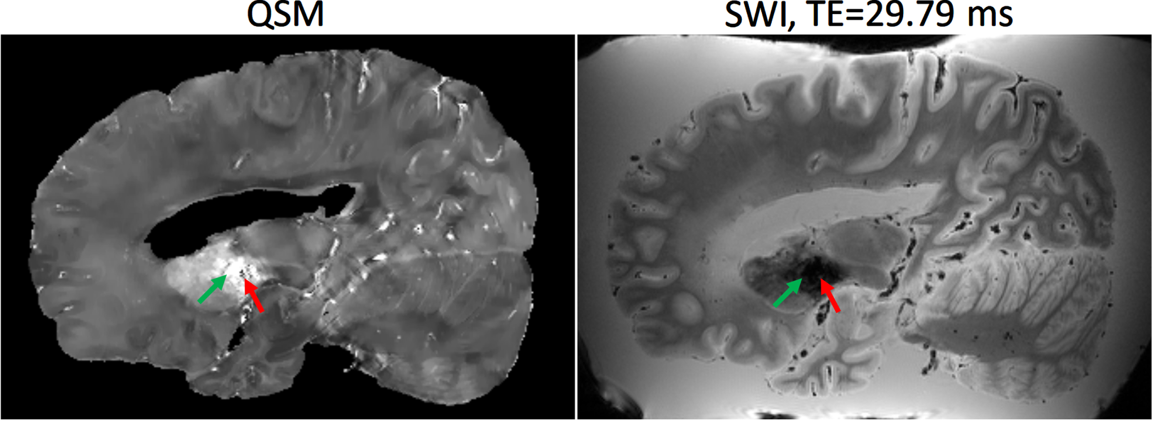 Example of Quantitative Susceptibility Mapping (QSM) (left) and Susceptibility Weighted Image (SWI) at echo time = 29.79 ms (right). The basal ganglia (green arrow) typically has a higher concentration of paramagnetic iron which exhibit hyperintensities on QSM, whereas diamagnetic calcifications exhibit hypointensities (red arrow).