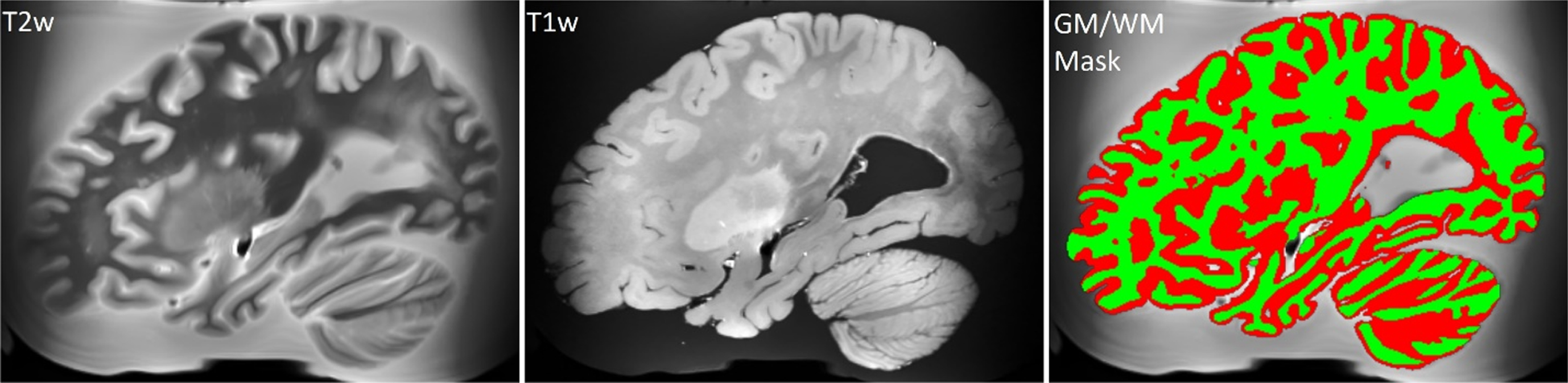 T2-weighted MRI registered in the space of the T1-weighted MRI scan, unprocessed T1-weighted MRI scan, and brain tissues segmentation derived from the T2-weighted scan (white matter is colored in green).
