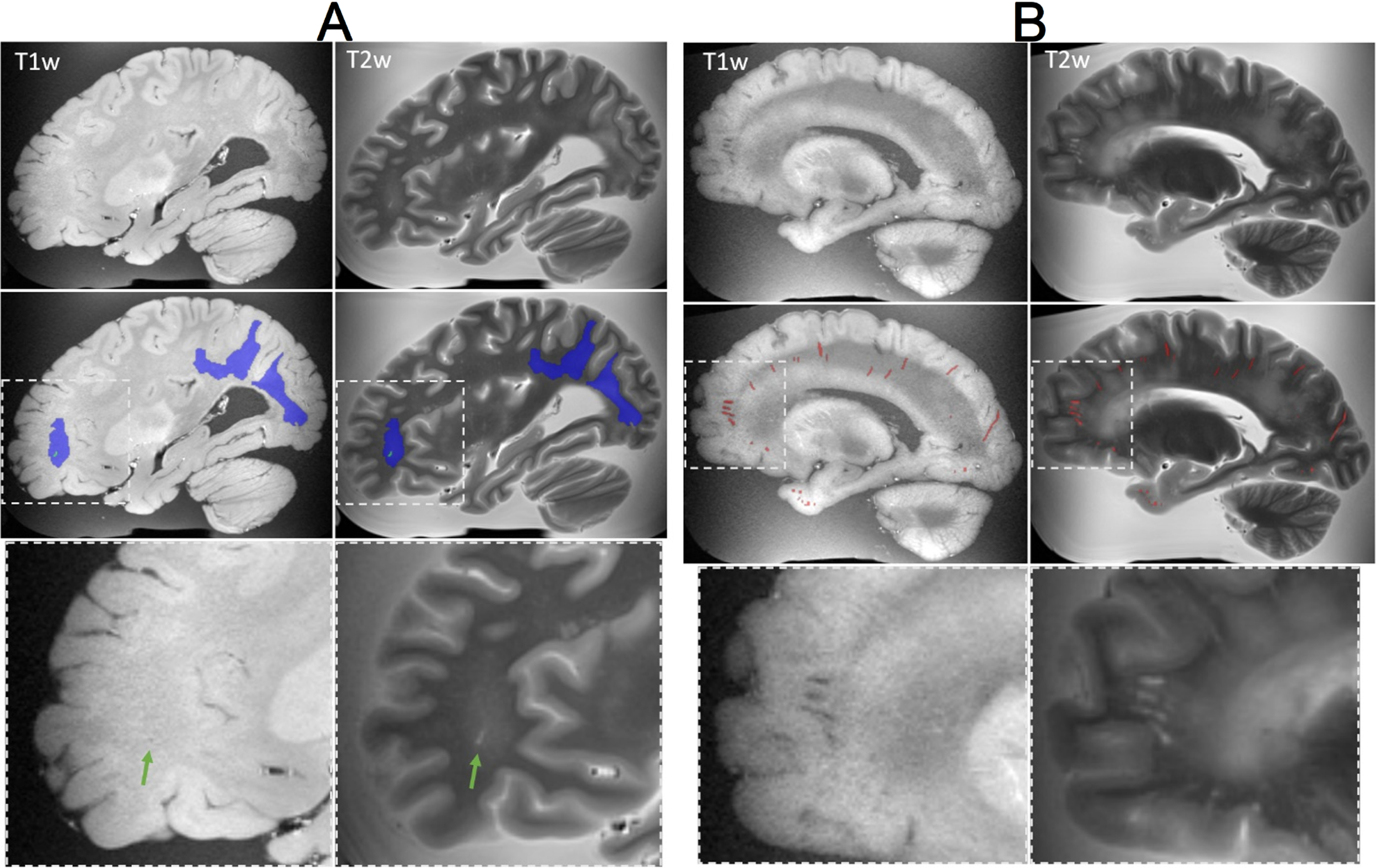 Examples of lesions captured on ex-vivo T1-weighted and T2-TSE MRI. A) (Top row) MRI showing white matter hyperintensities in the occipital and parietal regions, and a small infarction in the frontal lobe. (Middle row) manual segmentation of the white matter hyperintensities (blue) and infarction (green). (Bottom row) Magnified view of the infarction, indicated by the green arrow. B) (Top row) MRI showing enlarged perivascular spaces (EPVS) throughout the brain. (Middle row) manual segmentation of EPVS (red) by an expert. (Bottom row) Magnified view of EPVS in the frontal lobe.