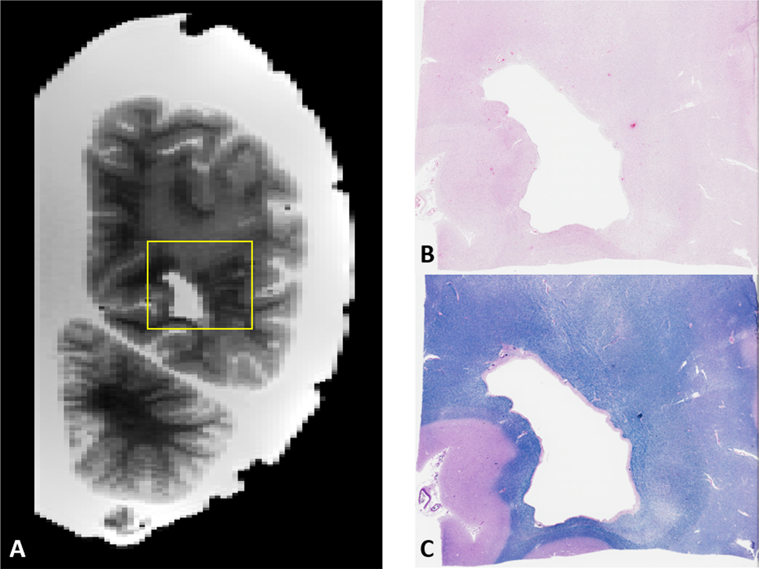 A) Example of image-guided histopathology with a coronal T2 slice of a posterior WMH. B, C) H&E and LFB stains of the same area respectively. Note the relative pallor of the stains in the same areas as the WMH in the MRI as well as the presence of numerous enlarged perivascular spaces on the right side of the image.
