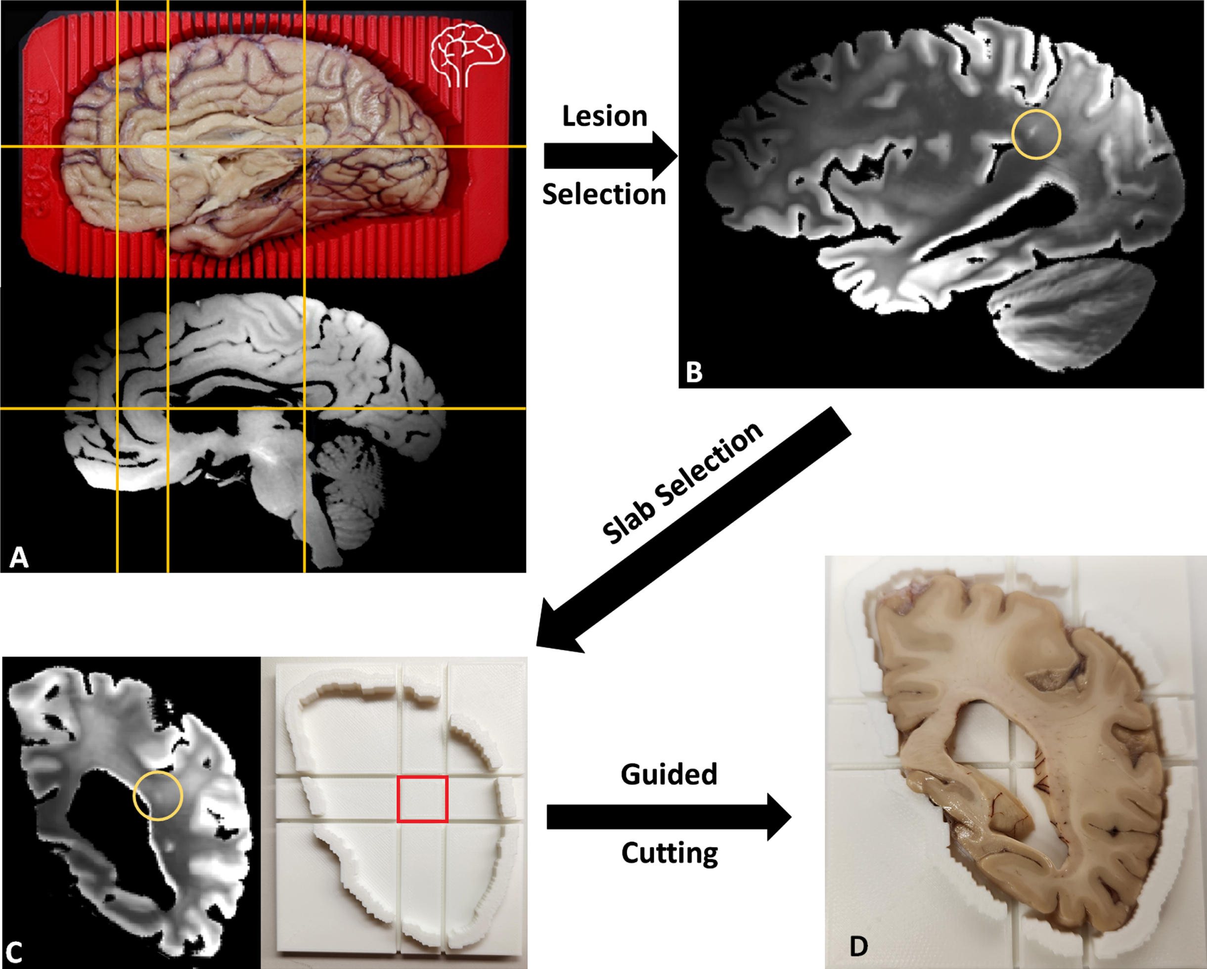 A) Left cerebral hemisphere prepped for cutting inside of 3D-printed brain cutting guide created using surface scanning along with the corresponding T2 weighted MRI with fluid removed. Yellow lines included to show correspondence of MRI to actual brain. B) A lesion small to be easily missed without MR guidance was selected. C) The corresponding coronal MRI view (cutting plane) of the lesion (circled) with a slab cutting guide corresponding to the slab. D) Slab #22 of the brain fitted within the slab cutting guide with a small lesion near the center of the target block that can be sampled to examine the target lesion microscopically.