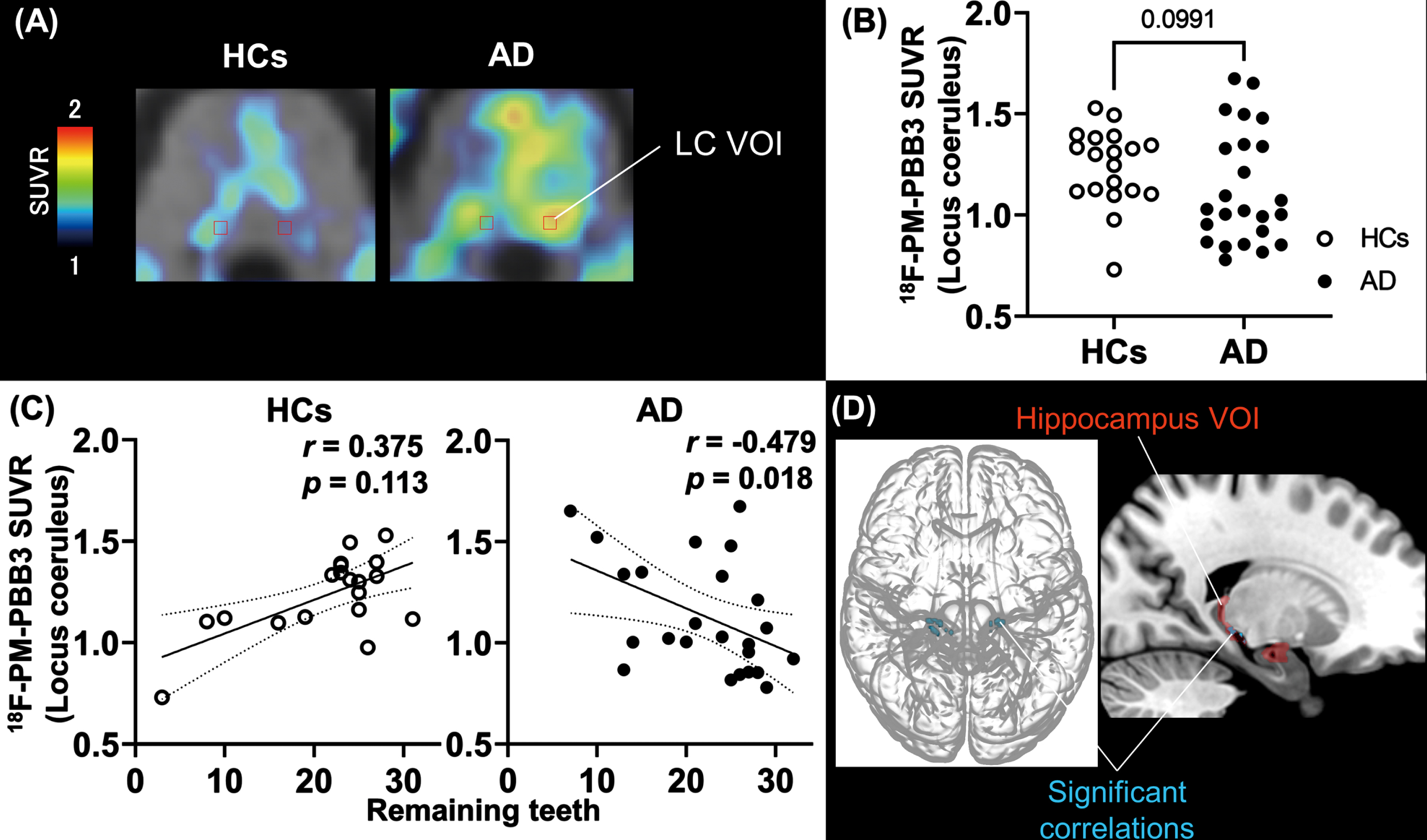 Number of remaining teeth and correlation with tau lesions in the locus coeruleus and hippocampal region. A) Anatomical volume of interest of locus coeruleus (LC-VOI) on normalized PET and MRI images of HCs and AD. B) Group comparison of tau PET SUVR values in LC-VOI between HCs and AD groups. The p value was estimated by Mann-Whitney U-test. Open and filled circles indicate HCs and AD-spectrum patients, respectively. C) Correlations of tau PET SUVR values in LC-VOI and the number of remaining teeth in HC and AD groups; r and p values were assessed by Spearman’s rank correlation test. D) T-maps illustrate that tau PET tracer accumulation was increased in the hippocampal region in association with an increase to LC in AD (uncorrected, p < 0.001). The hippocampus VOI (red) is also overlaid in the right brain image. The cluster size threshold was set to zero according to the size of the LC-VOI. The statistical map was overlaid on the MNI brain. AD, Alzheimer’s disease; HCs, healthy controls; LC, locus coeruleus; MNI, Montreal Neurological Institute; PET, positron emission tomography; SUVR, standard uptake value ratio; VOI, volume of interest.