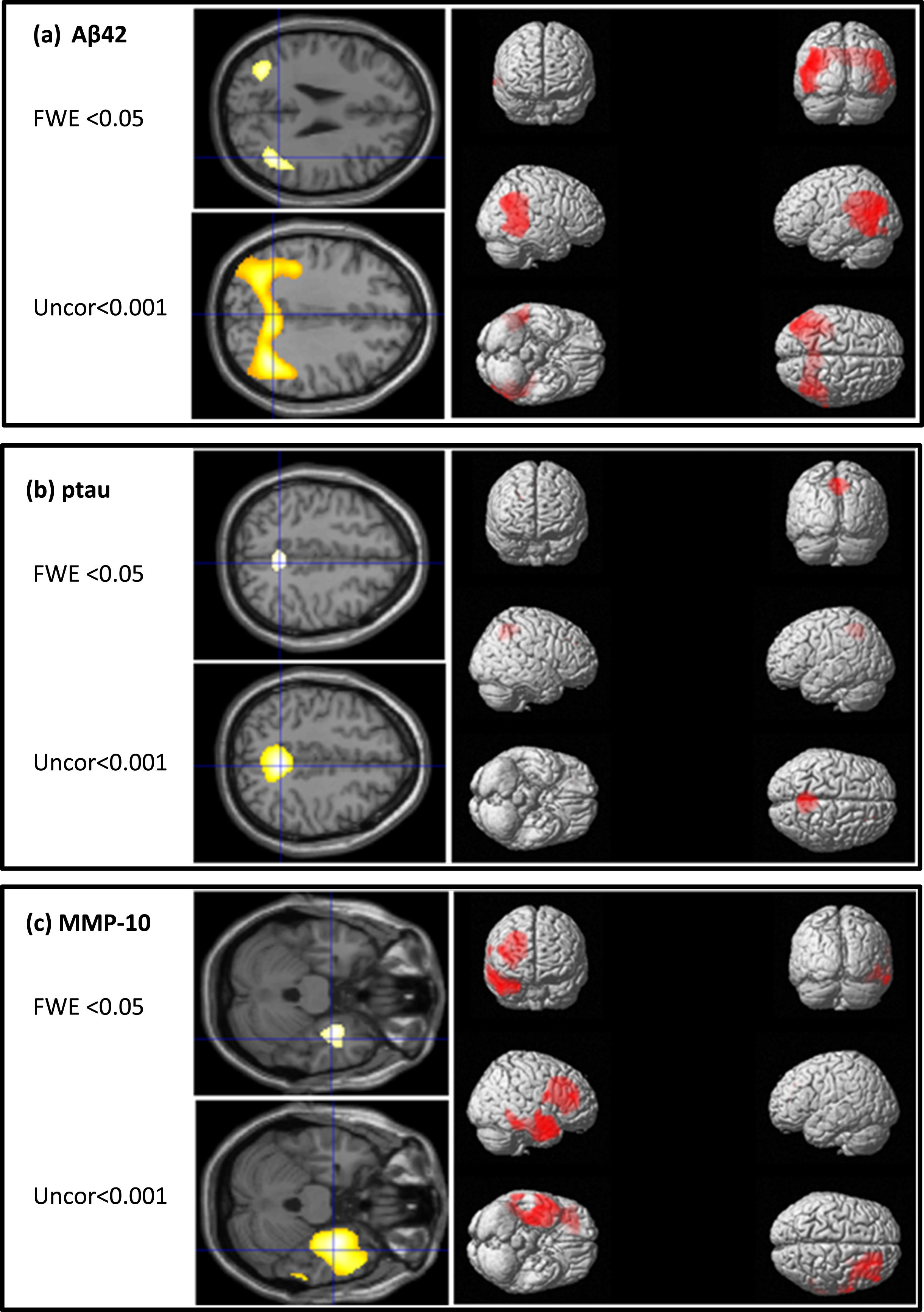 Overlays of clusters of hypoperfusion on MRI associated with changes in (a) Aβ42, (b) ptau, and (c) MMP-10 at FEW <0.05 and uncorrected <0.001 levels and surface rendering at the uncorrected <0.001 level.