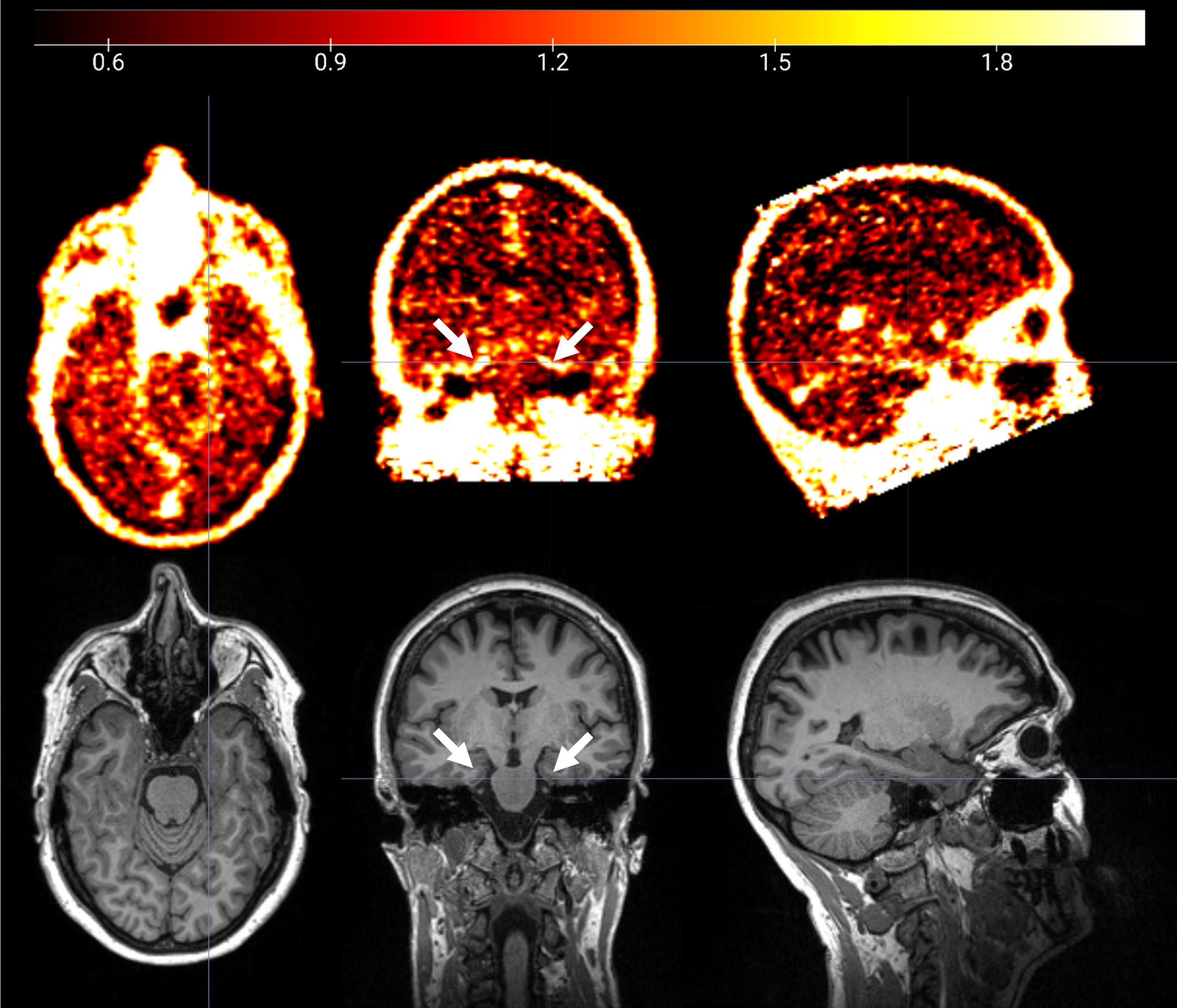 18F-GE180 PET SUVR image (upper panel) and T1 structural MRI image (lower panel) from a cognitively impaired participant. Elevated 18F-GE180 uptake following the contour of entorhinal cortex and parahippocampal gyrus (pointed by white arrows) was observed.