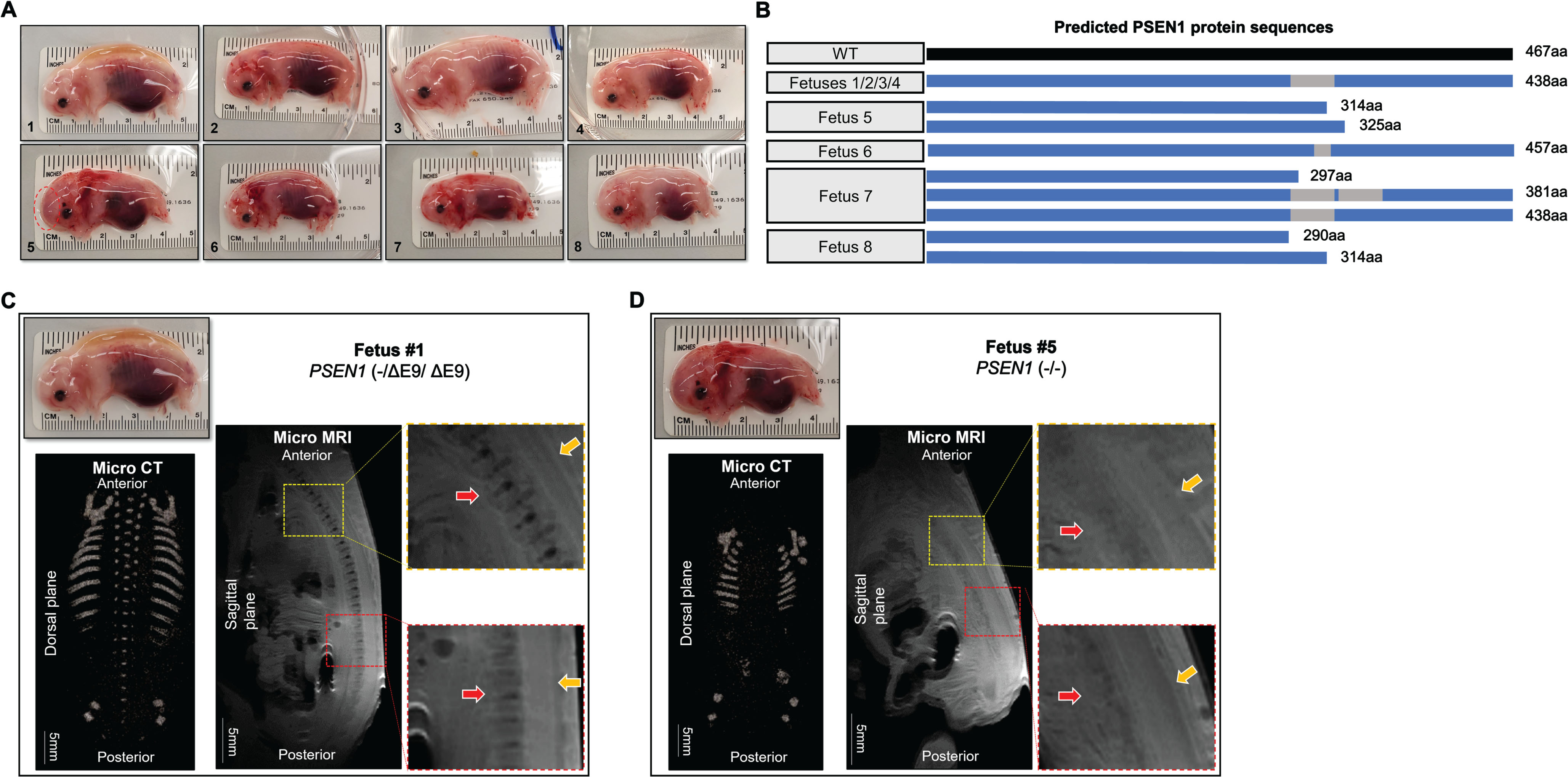 Defective vertebral development in PSEN1 targeted fetuses. A) Images of PSEN1 targeted fetuses collected at day 40. While 4 fetuses (1∼4) had a normal appearance (top 4 panels), other 4 fetuses (5∼8) showed abnormalities in size and shape. B) Predicted PSEN1 protein sequences expressed in the PSEN1 targeted piglets. Fetuses 1∼4 were expected to express a single protein translated from an exon 9 deleted allele, whereas fetuses 5∼8 were expected to express smaller truncated protein(s). C, D) Abnormal skeletal development in PSEN1-targeted fetuses. In contrast to the normal axial skeleton in fetus 1 (left panel), defective development of vertebrae and ribs was detected in fetus 5 (right panel) by micro-CT and MRI imaging and analysis. In the micro-MRI images, the yellow rectangular box represents the thoracic vertebrae and the red box represents the lumbar and sacral vertebrae. Red arrows indicate vertebrae and intervertebral discs and yellow arrow indicates the spinal canal.