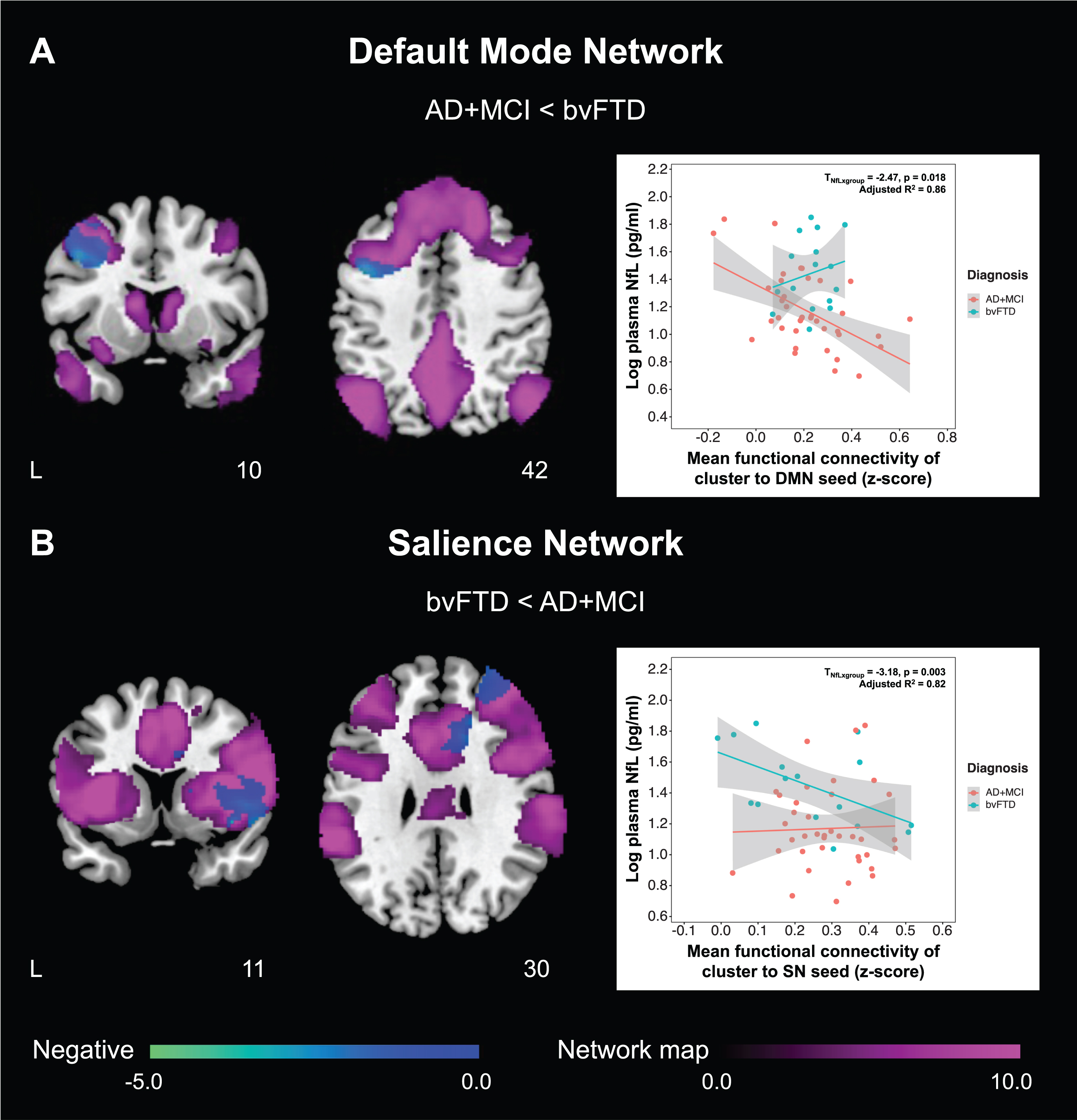 AD + MCI and bvFTD patients show divergent changes in the associations between plasma NfL and fConflictunctional connectivity of default mode and salience networks. Group functional connectivity association maps, depicting brain clusters that show significant negative associations (cool color) between plasma NfL and (A) functional connectivity to the left posterior cingulate cortex (default mode network seed) in AD + MCI patients as well as (B) functional connectivity to the right anterior insula (salience network seed) in bvFTD patients, are overlaid on their respective group network masks generated from cognitively normal controls (purple color). Both maps are displayed on the Montreal Neurological Institute template brain. Scatterplots on the right depict the relationship between plasma NfL and mean functional connectivity of these clusters to the (A) default mode and (B) salience network seeds respectively for both groups. (A) Higher plasma NfL was associated with lower default mode network functional connectivity of the left posterior cingulate cortex to the left dorsolateral prefrontal cortex in AD + MCI patients. The association between plasma NfL and mean functional connectivity of this cluster to the left posterior cingulate cortex was significantly higher in AD + MCI compared to bvFTD patients. By comparison, (B) higher plasma NfL was associated with lower salience network functional connectivity of the right anterior insula to a cluster comprising the right frontal gyrus, insula, putamen, middle and anterior cingulate cortex in bvFTD patients. The association between plasma NfL and mean functional connectivity of this cluster to the right anterior insula was significantly higher in bvFTD compared to AD + MCI patients. NfL, neurofilament light; AD, Alzheimer’s disease; MCI, mild cognitive impairment; bvFTD, behavioral variant frontotemporal dementia; DMN, default mode network; SN, salience network.