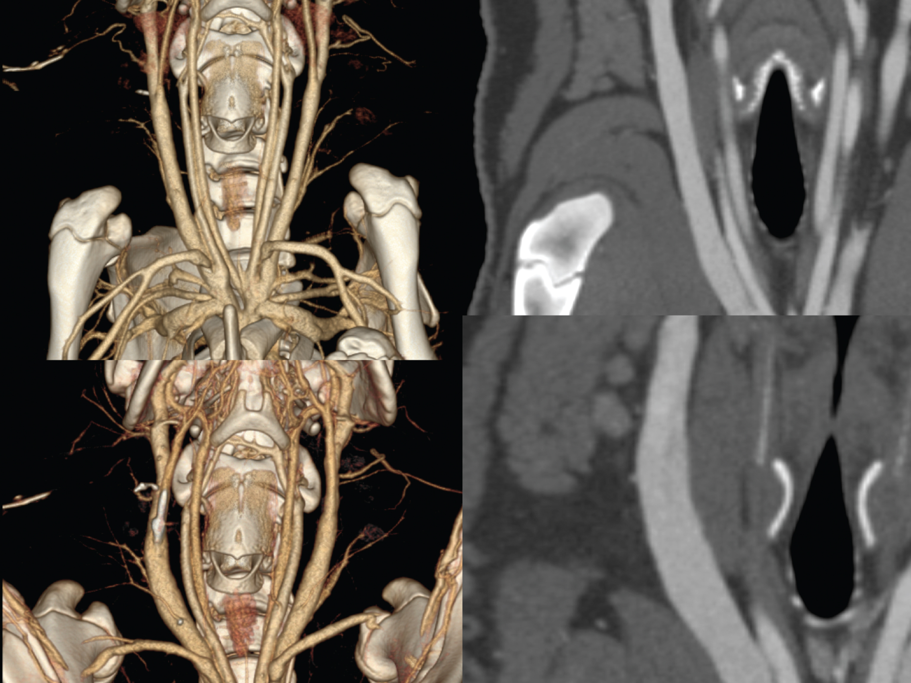 Supine position (upper images) as VRT (left) and MPR (right) compared to prone position (lower images) displayed as VRT and MPR focusing on the external jugular vein.