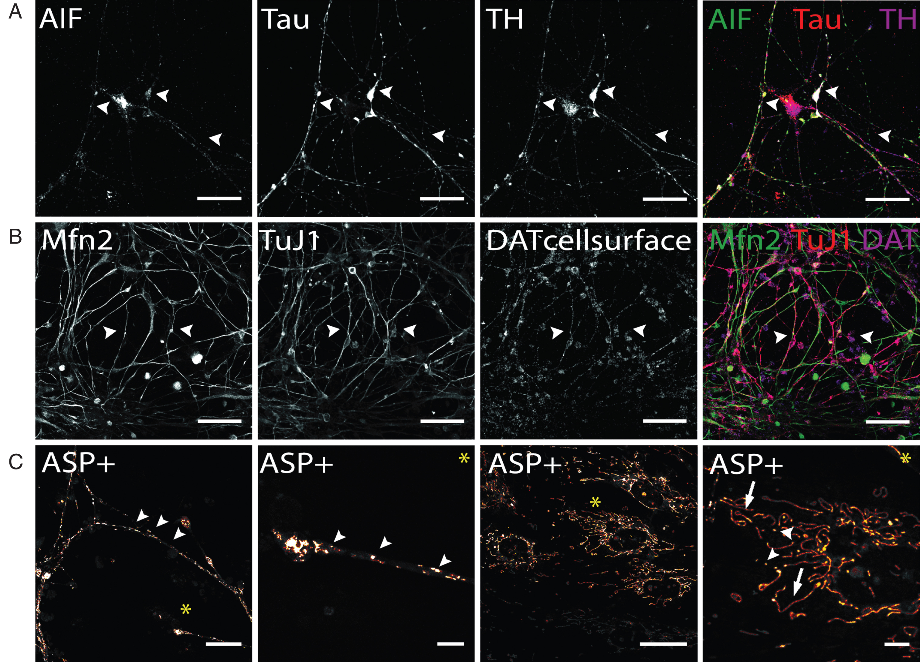 Immunocytochemical analysis of mitochondria distribution in hiPS cell-derived DA neurons and DAT specific uptake of fluorescent dye ASP+. (A) Immunostaining of mitochondrial intermembrane protein AIF in dopaminergic neurons after 50 days of terminal differentiation. AIF (green) is found to be present in cell soma and neurites (arrow heads). Dopaminergic neurons can be identified by co-localized signals of Tau (red) and TH (magenta). Scale bar: 50μm. (B) Mitochondrial fusion protein Mfn2 (green) can be visualized by immuno-cytochemistry and is evenly distributed throughout cells. Since not only neuronal cells are positively stained for Mfn2, co-staining with neuronal marker (here: TuJ1, red) and dopaminergic marker DAT was applied to identify Mfn-signals exhibited by DA neurons. Scale bar: 50μm. (C) Live cell imaging experiments in hiPS cell-derived DA neurons show DA-specific uptake of fluorescent ASP+ dye into neurons and accumulation in mitochondria. Zoom images show distribution of mitochondria along neurites and neurite endings, with mitochondrial morphology being round and punctual (arrow heads), whereas mitochondria located in cell somas are more elongated (arrows). Scale bar: 25μm, Zoom images: 5μm.