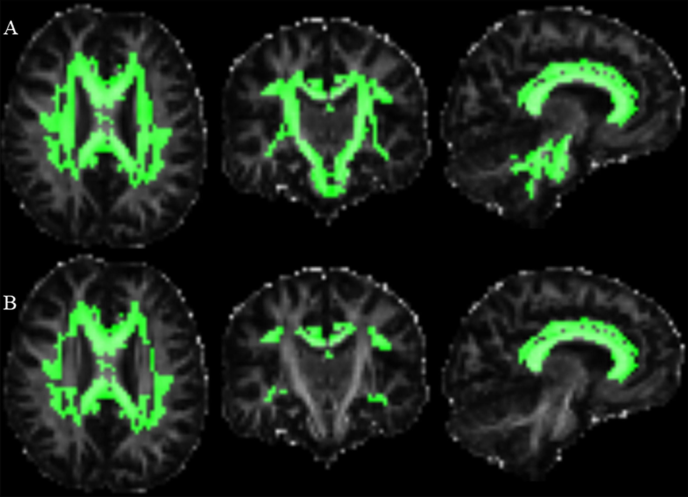 
Brain regions with different MK or FA values among groups. Dispersion space imaging shows brain regions with different diffusion values among three groups (areas highlighted in green). Regions with differences in MK values among groups (A), and regions with differences in FA values among groups (B). The MNI coordination of the picture is X46; Y41; Z36.