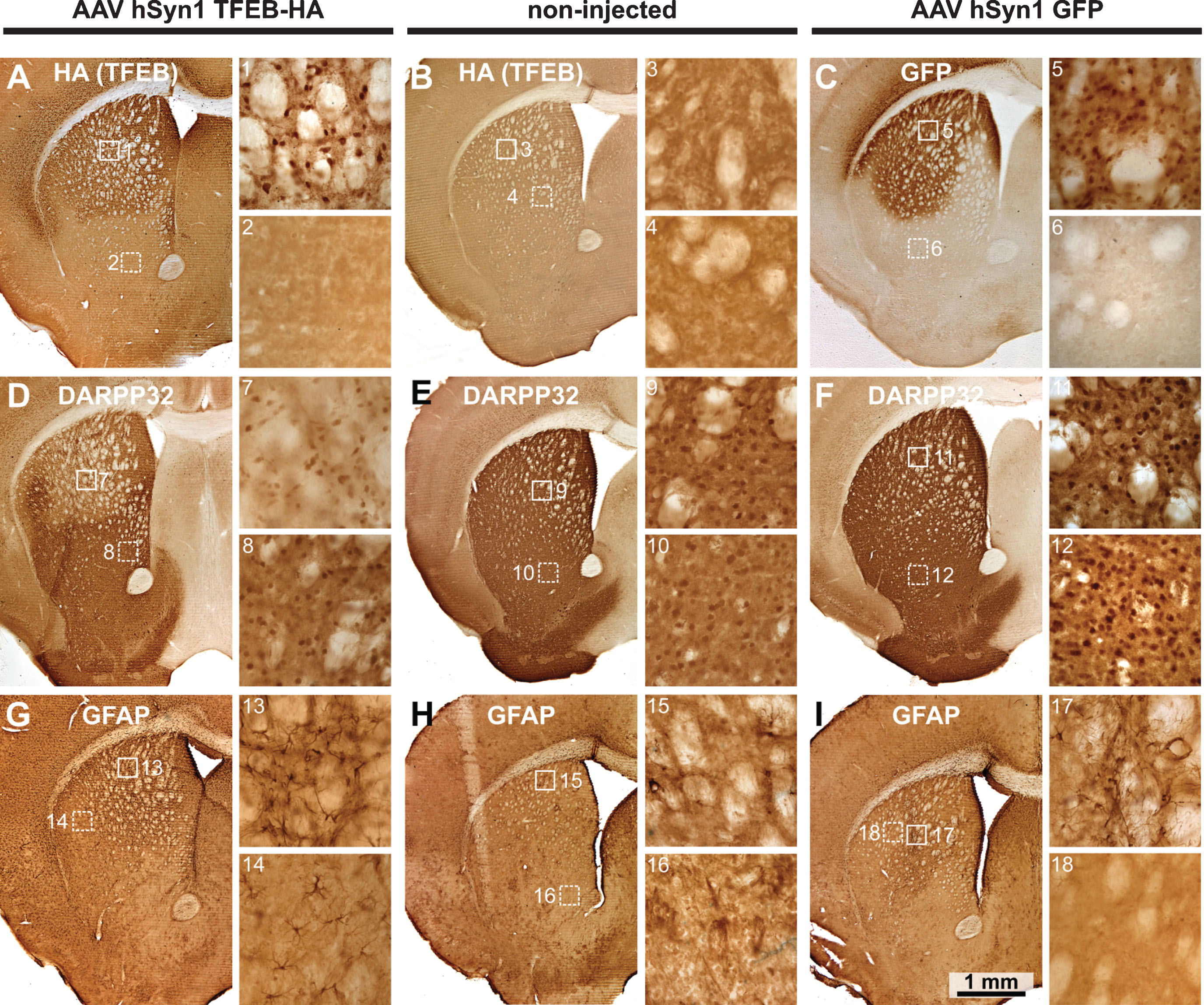 Immunohistochemistry for TFEB-HA, DARPP32 and GFAP in mice injected with AAV hSyn1 TFEB-HA, AAV hSyn1 GFP or non-injected and examined 2 months post-injection: Immunoperoxidase labeling for HA (TFEB-HA) (A, B) or GFP (C) within the injected or control striatum. Images from corresponding sections stained with DARPP32 (D, E, F) and GFAP (G, H, I) show extent of labeling within the striatum. Numbered boxes correspond to areas displayed in the enlargements to the right. DARPP32 staining of cell bodies and processes is diminished in the TFEB-HA affected area of striatum (D). Note increased GFAP labeling in the area of striatum affected by TFEB-HA injection (G). N = 2 mice per treatment group.