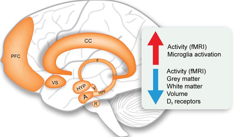 Limbic system changes in Huntington’s disease. Schematic representation of the structures of the limbic system and overview of the main upregulated and downregulated changes (indicated by the arrows). A, amygdala; CC, cingulate cortex; F, fornix; fMRI, functional magnetic resonance imaging; HIPP, hippocampus; HYP, hypothalamus; PFC, prefrontal cortex; R, raphe nucleus; V, ventral tegmental area; VS, ventral striatum.